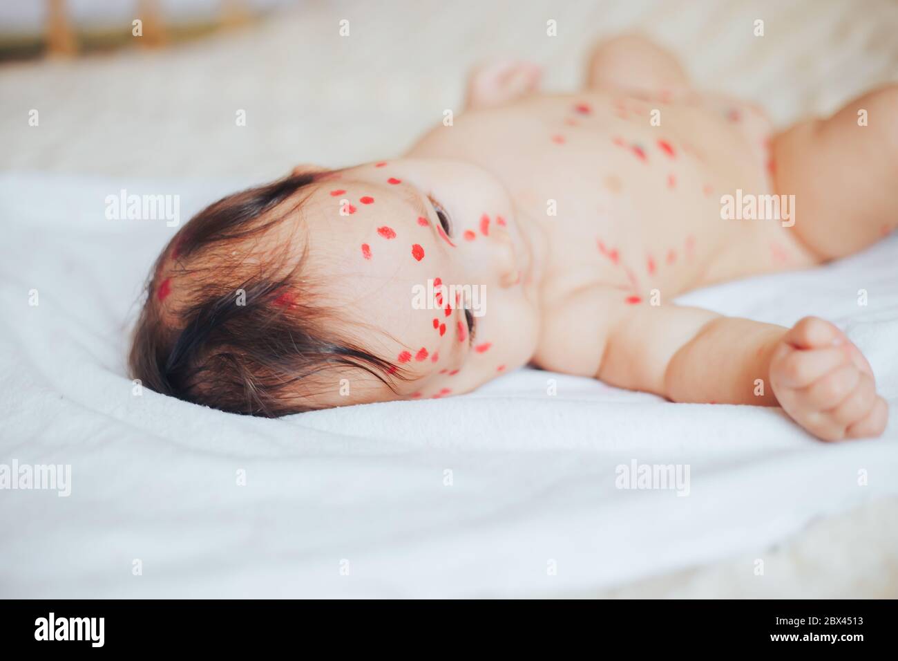 Varicelle Bebe Banque D Image Et Photos Alamy