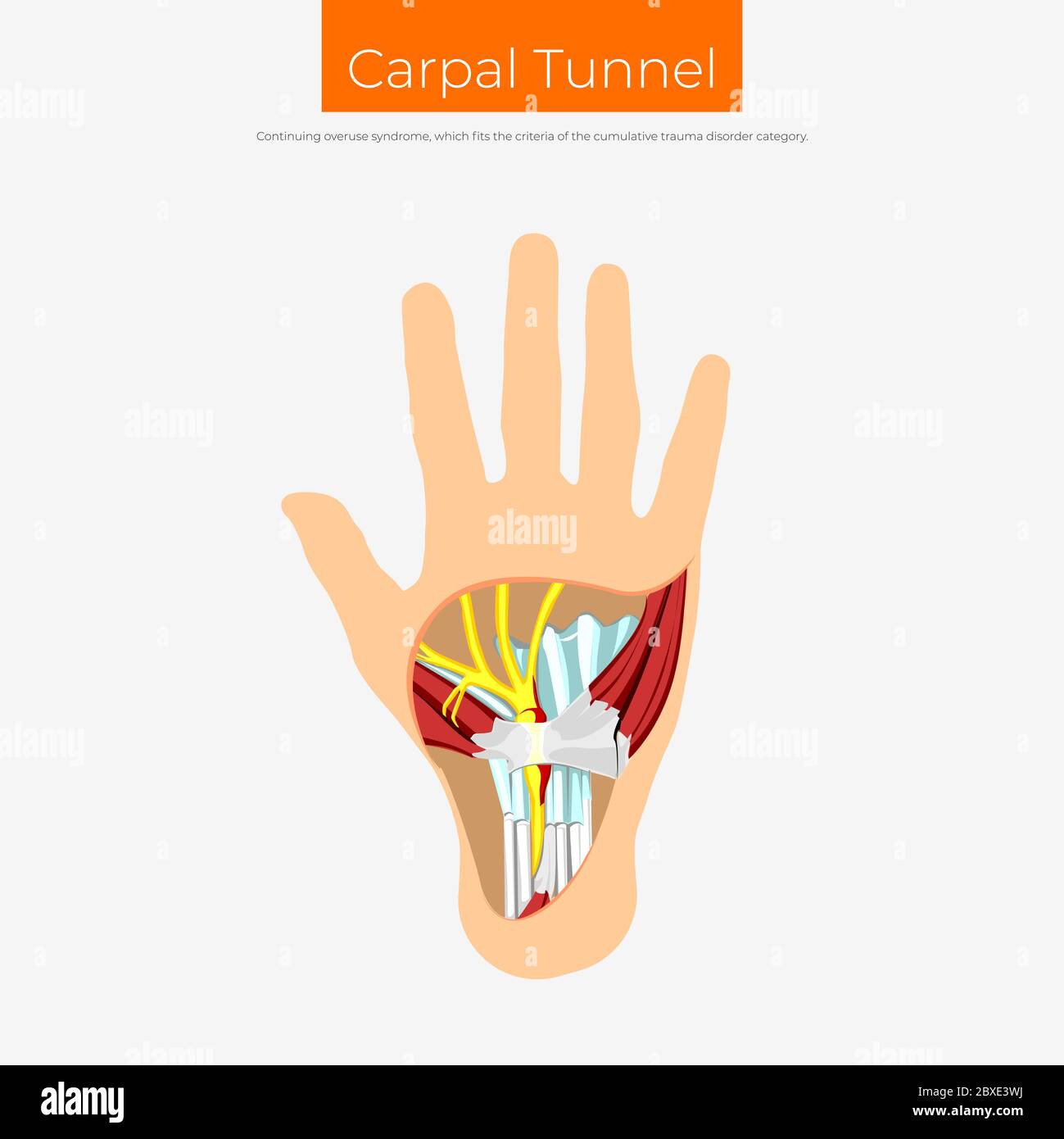 Affiche du schéma du syndrome du canal carpien Illustration de Vecteur