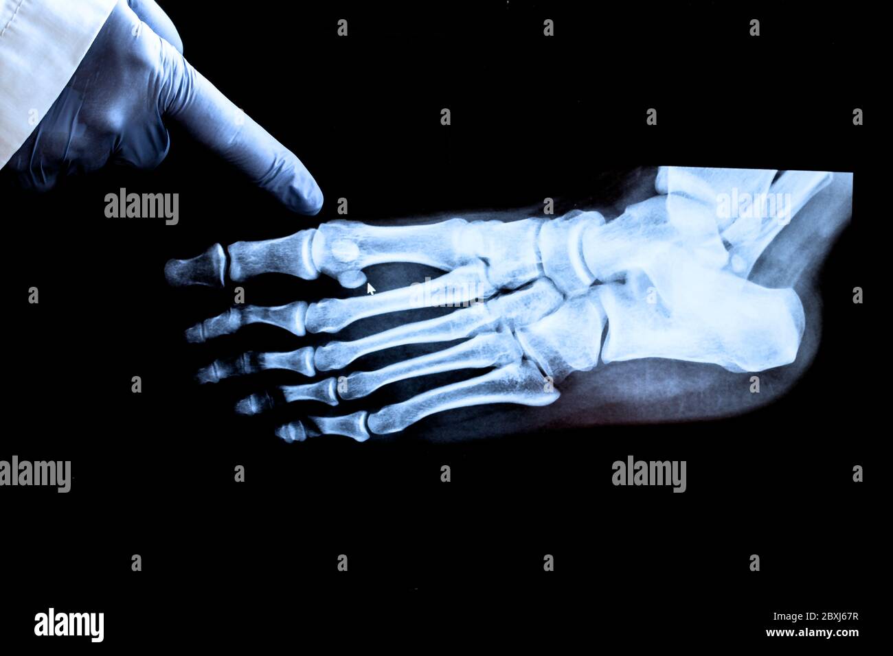 Rayons X du pied. Le médecin pointe un doigt sur les croissances de l'os. Banque D'Images Rayons X du pied. Le médecin pointe un doigt sur les croissances de l'os. Banque D'Images