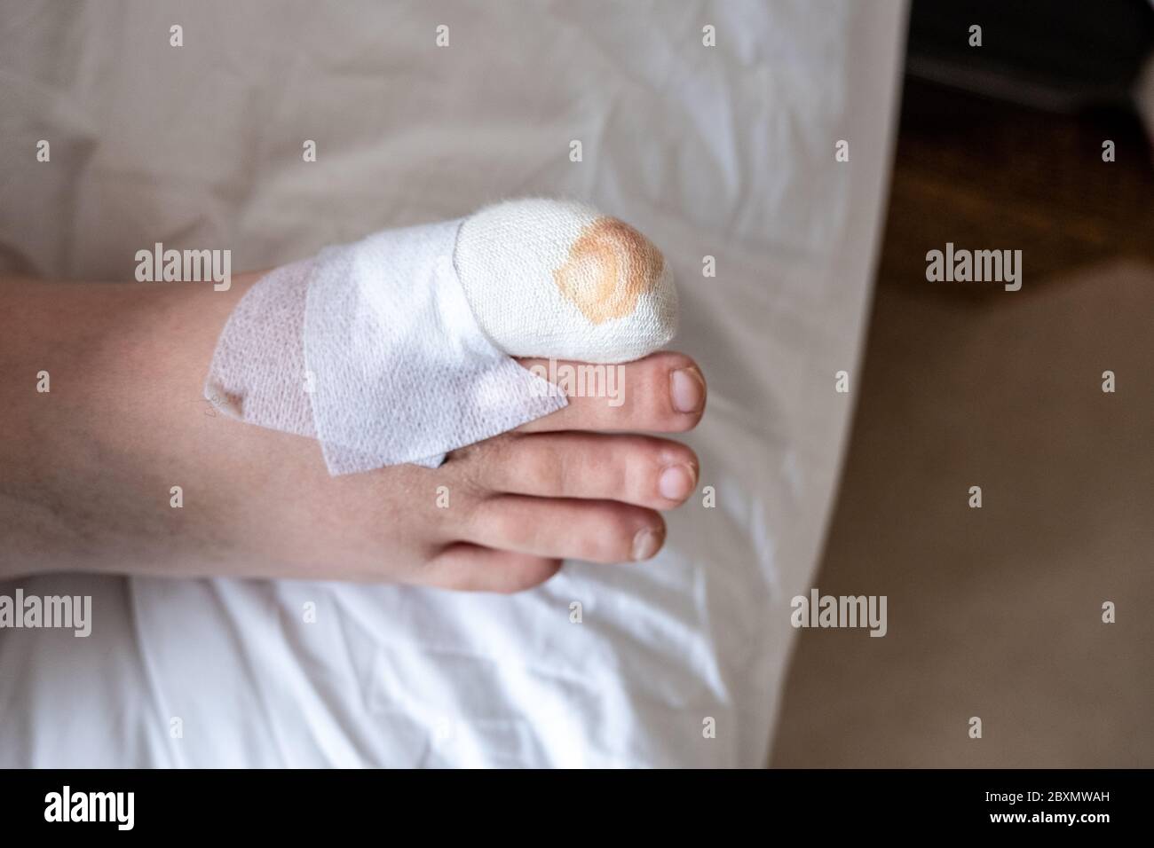 Laura a eu un ongle enlevé et un coupé après trois tentatives infructueuses de faire sortir les ongles du pied. L'opération a pris 2 heures. Banque D'Images