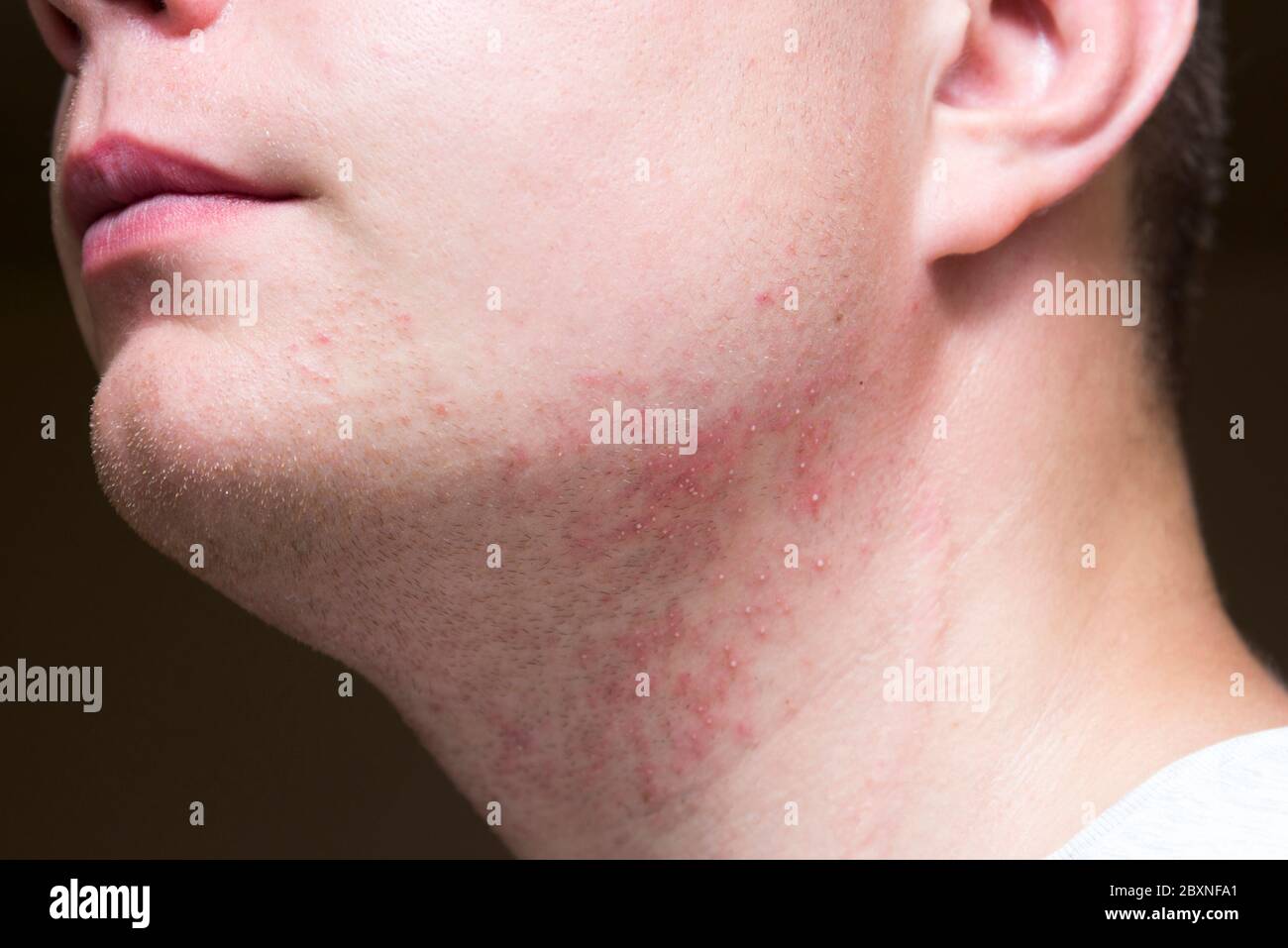 Irritation sévère après rasage sur le cou d'un homme, gros plan Photo Stock  - Alamy