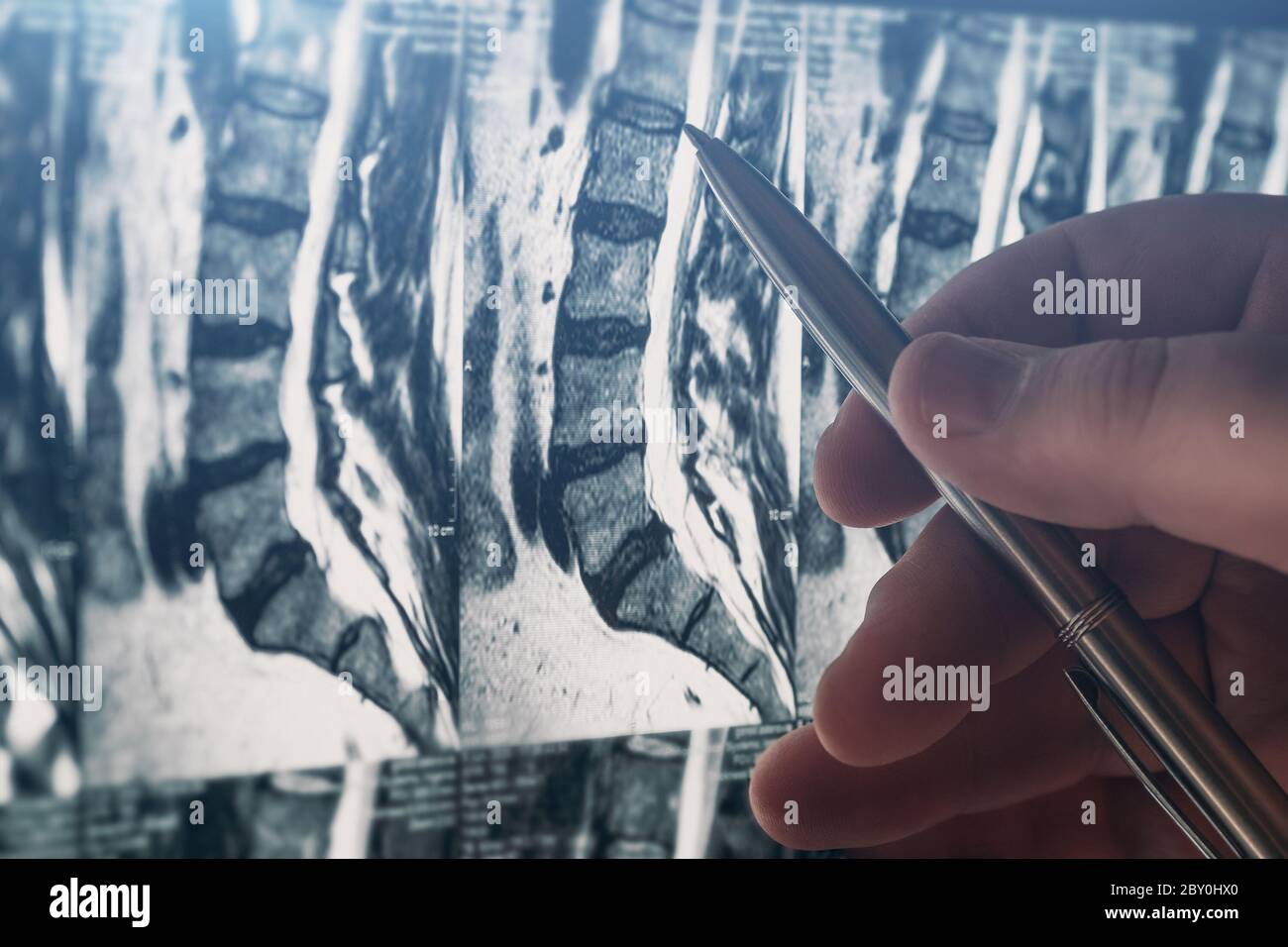 Le médecin examine l'IRM de la colonne lombaire avec des disques pincés de la colonne vertébrale et des nerfs, des points aux zones problématiques par stylo, gros plan. Banque D'Images