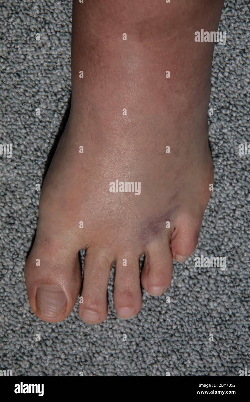 gonflement sévère et hématome du pied gauche après flexion et étirement du ligament Photo Stock
