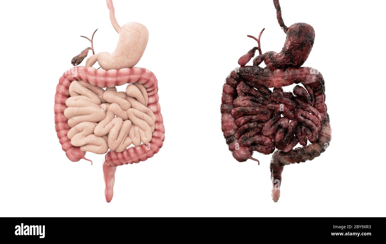 intestins sains et intestins de maladie sur isolat blanc. Concept médical d'autopsie. Cancer et problème de tabagisme. rendu 3d Banque D'Images