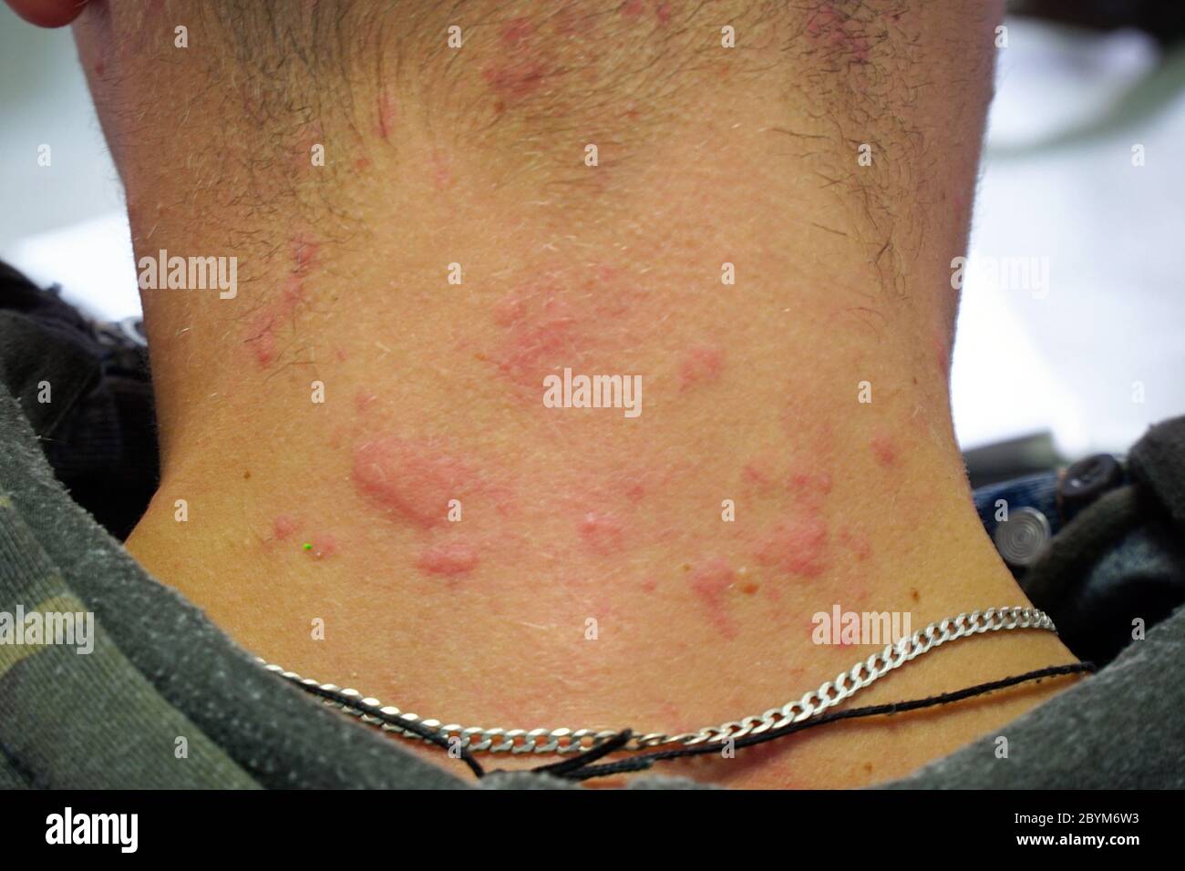 Éruption cutanée rouge sur le cou. Réaction allergique sur la peau ...
