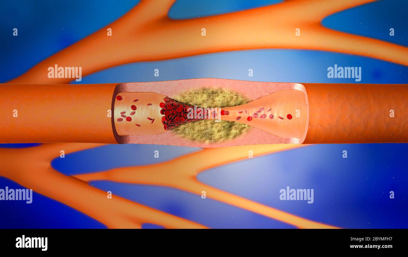 3d illustration d'un précipité et rétrécissement des vaisseaux sanguins ou de l'artériosclérose Banque D'Images