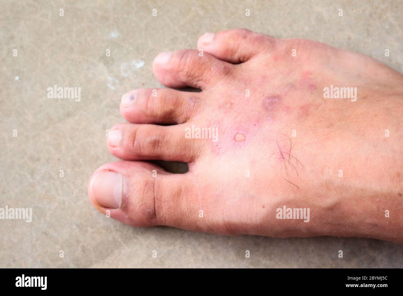 gros plan peau psoriasis des pieds de l'athlète champignon, pied de hong kong, maladie des pieds Banque D'Images