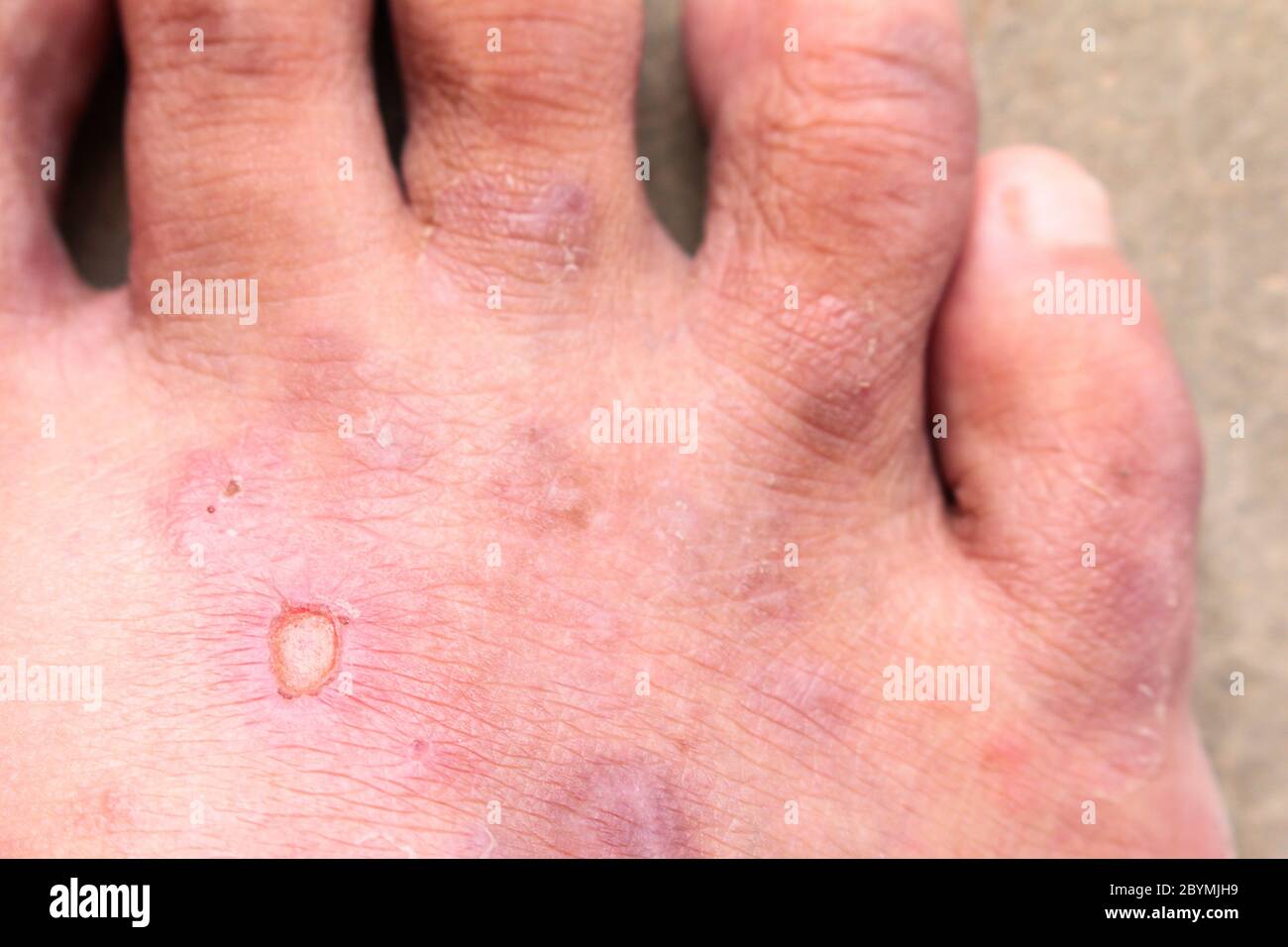 gros plan peau psoriasis des pieds de l'athlète champignon, pied ...