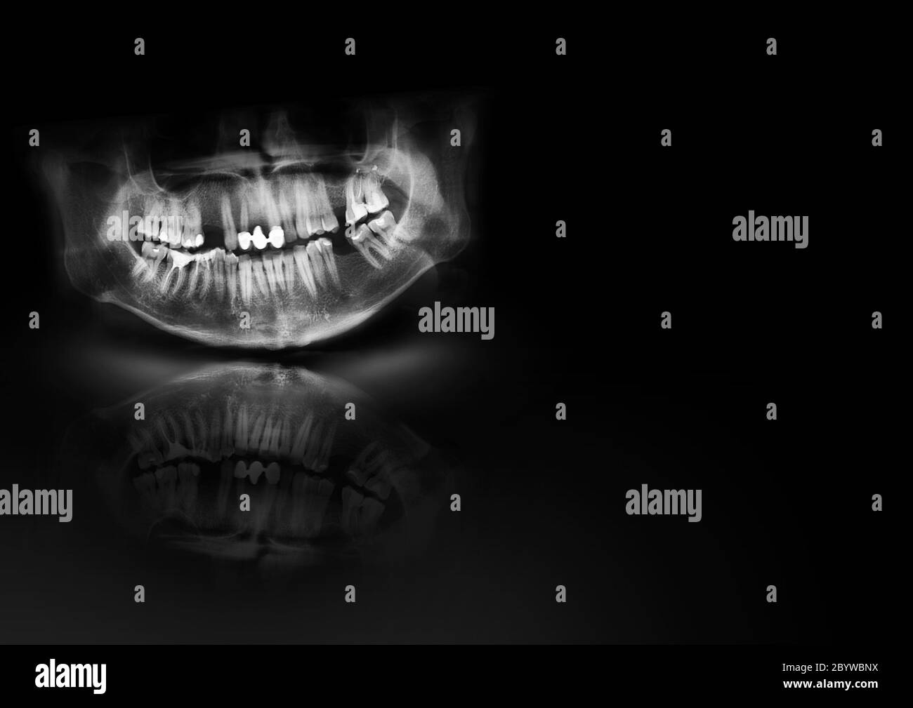 La radiographie panoramique est une radiographie dentaire à balayage de la mâchoire supérieure maxillaire et de la mâchoire inférieure mandibule. Arrière-plan noir avec lumière, ombre et fond Banque D'Images