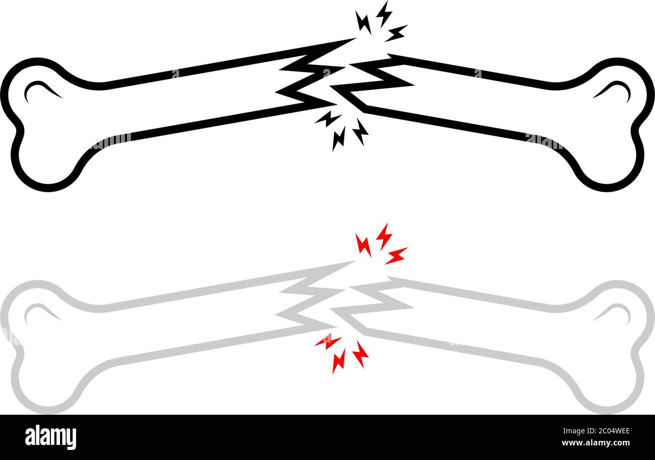 Illustration d'un vecteur de fracture osseuse, d'un os brisé humain Illustration de Vecteur