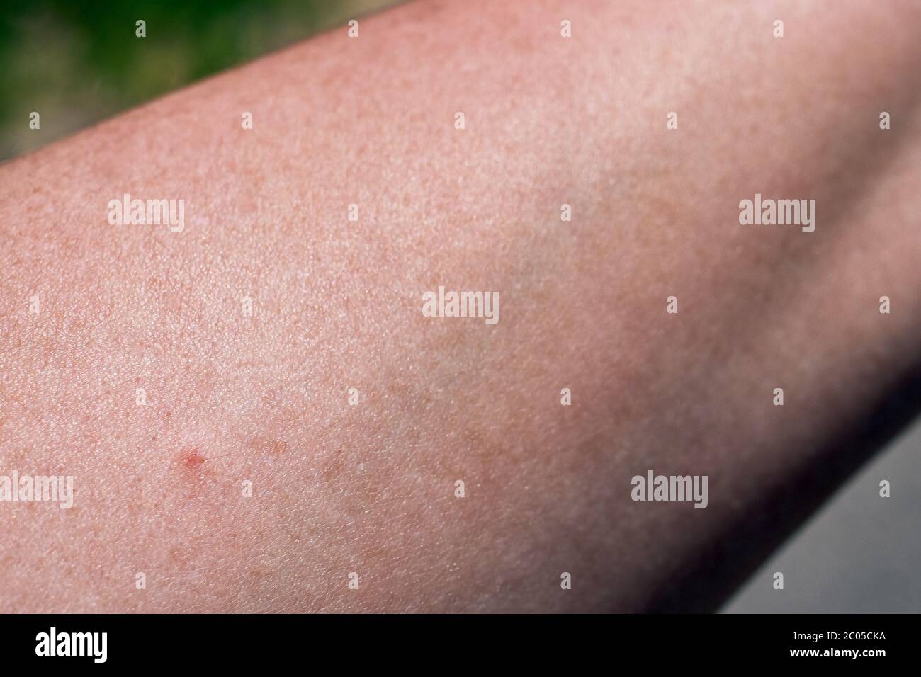 Morsure de tique sur le bras d'une femme. Petit point rouge, rougeur de la peau, blessure et conséquences juste après la piqûre d'insecte. Documenté le jour ensoleillé du printemps. Banque D'Images