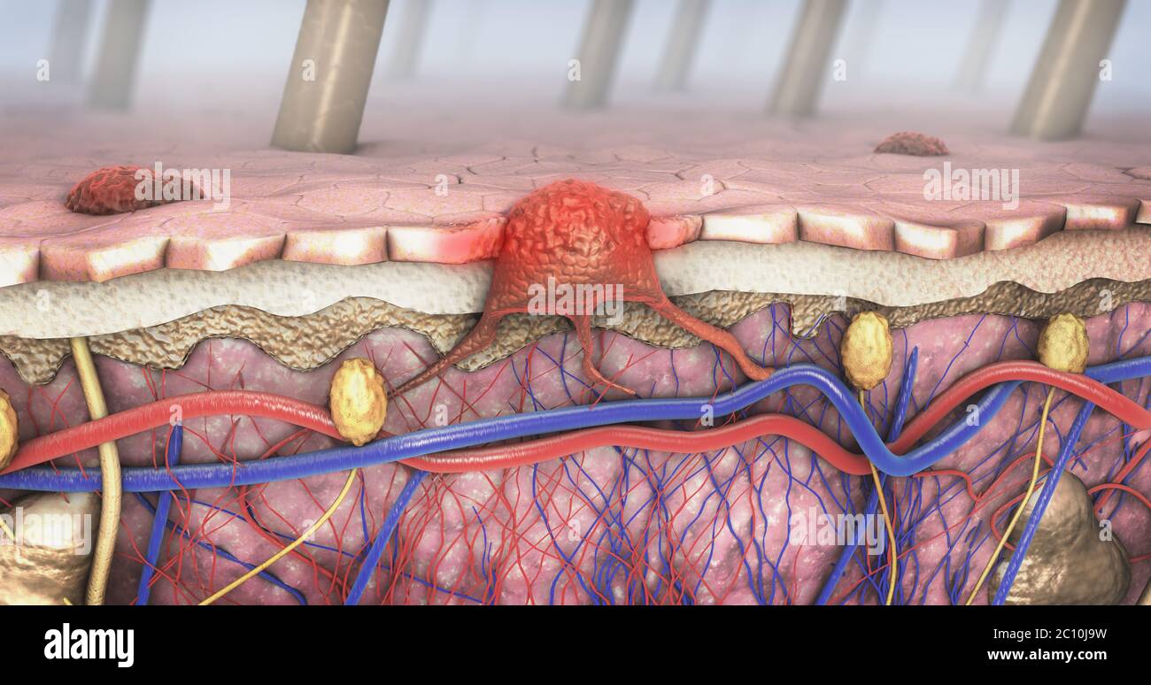 Illustration 3d d'une section d'un mélanome de la peau malade qui entre dans la circulation sanguine et lymphatique intestinal Banque D'Images