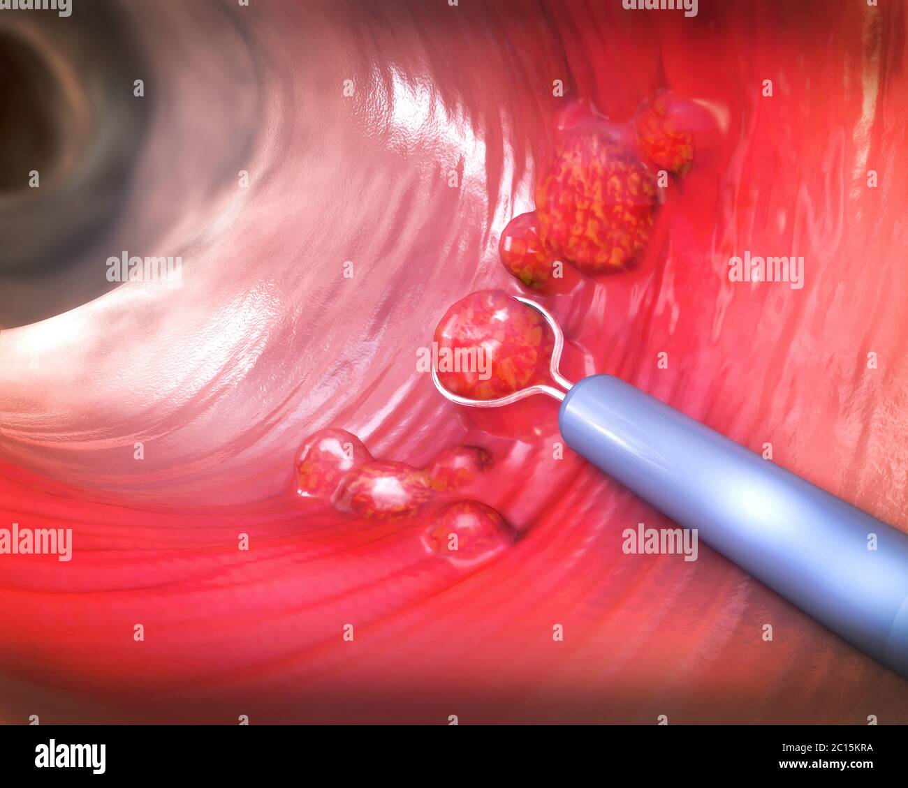 Retrait d'un polype colique avec une boucle de fil électrique pendant une coloscopie - illustration 3d Banque D'Images