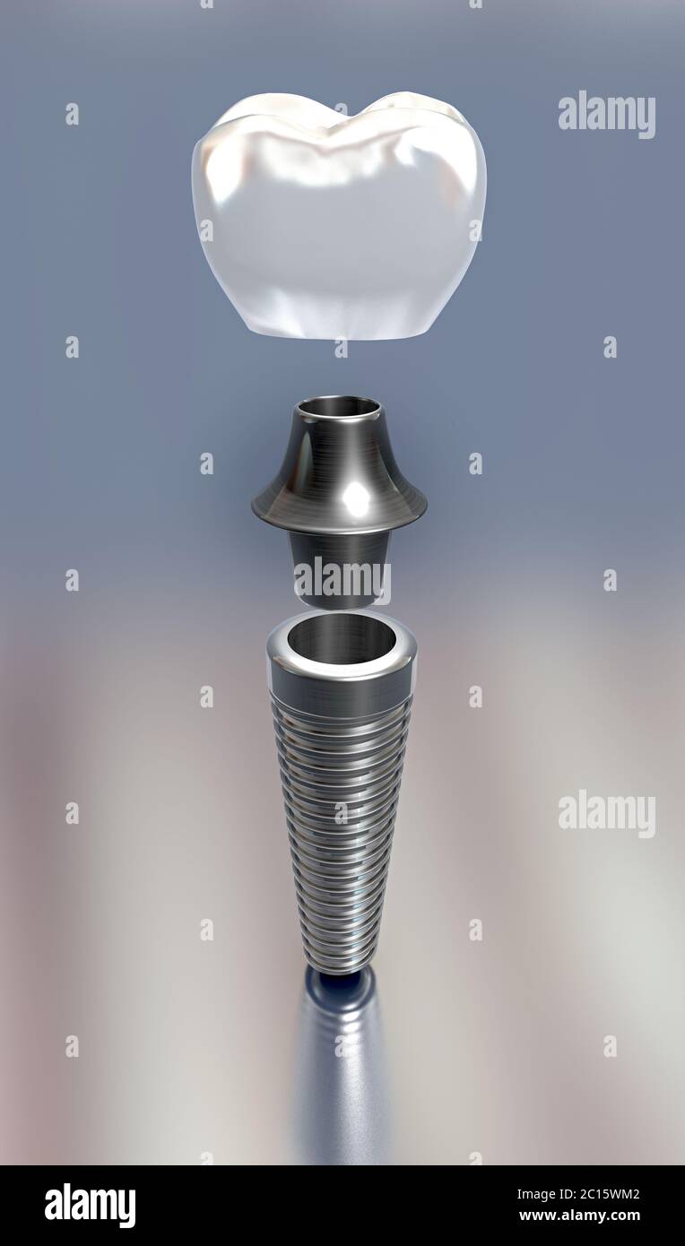 3d illustration de trois différentes parties d'un implant Banque D'Images