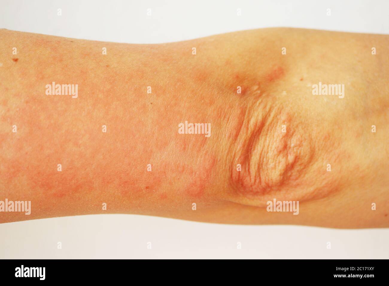 Pustules rouges et vésicules sur la peau de la main comme symptômes de la photodermatite. Réaction allergique à la lumière du soleil. Allergie Banque D'Images