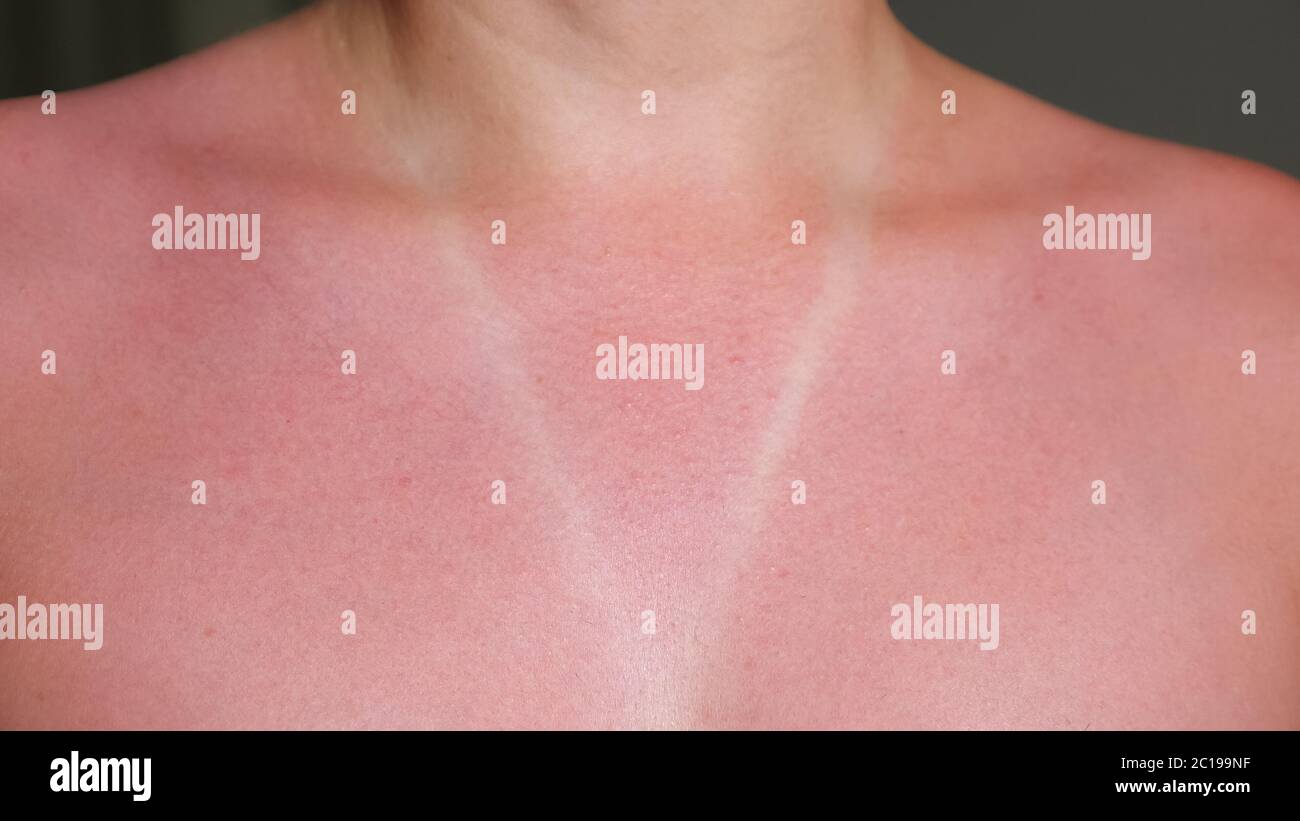jeune femme coups de soleil poitrine nue et cou avec bronzage rouge autour  de blanc conçu maillot de bain impression extrême vue rapprochée Photo  Stock - Alamy