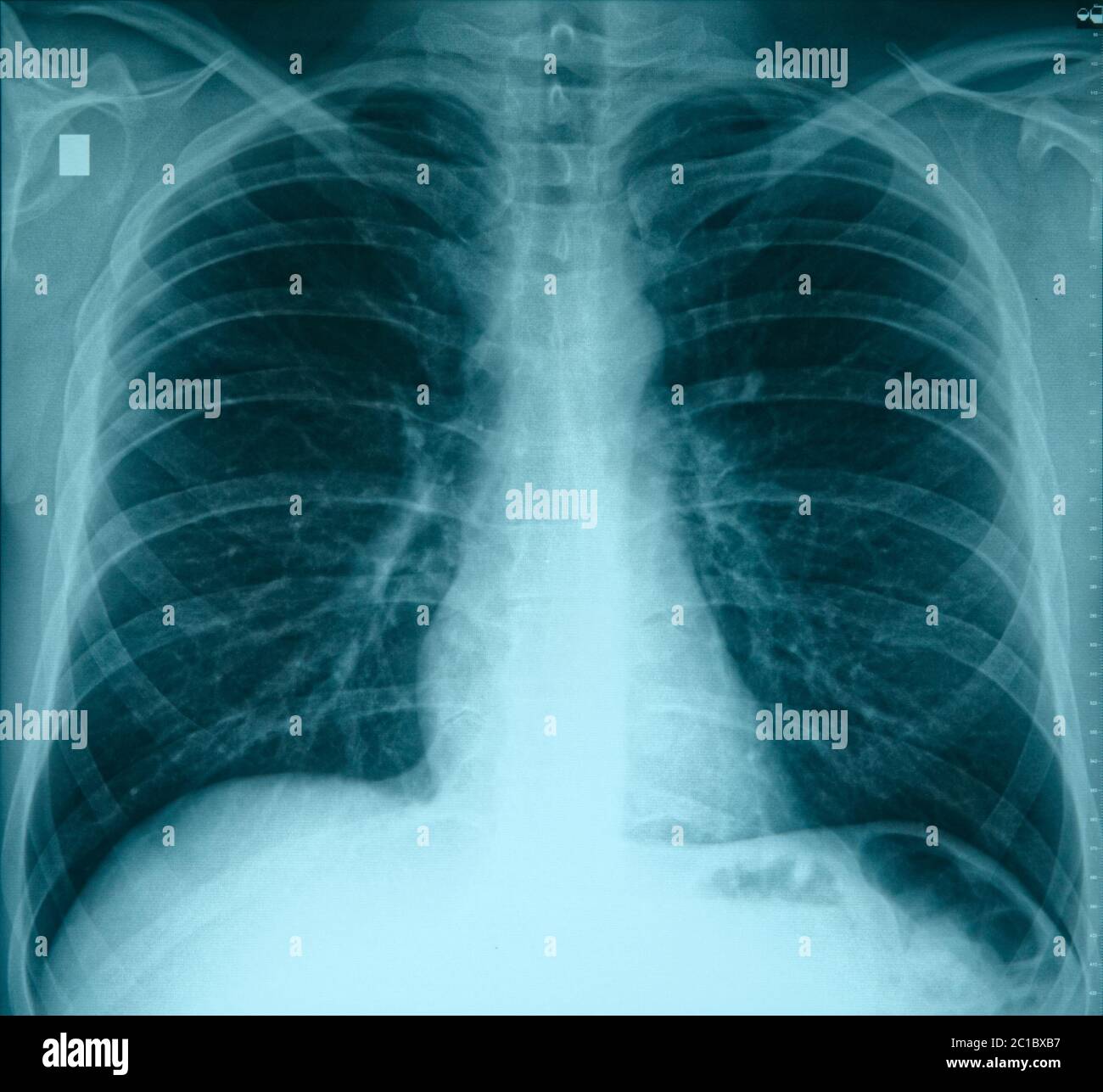 Normal healthy lungs Banque de photographies et d'images à haute ...
