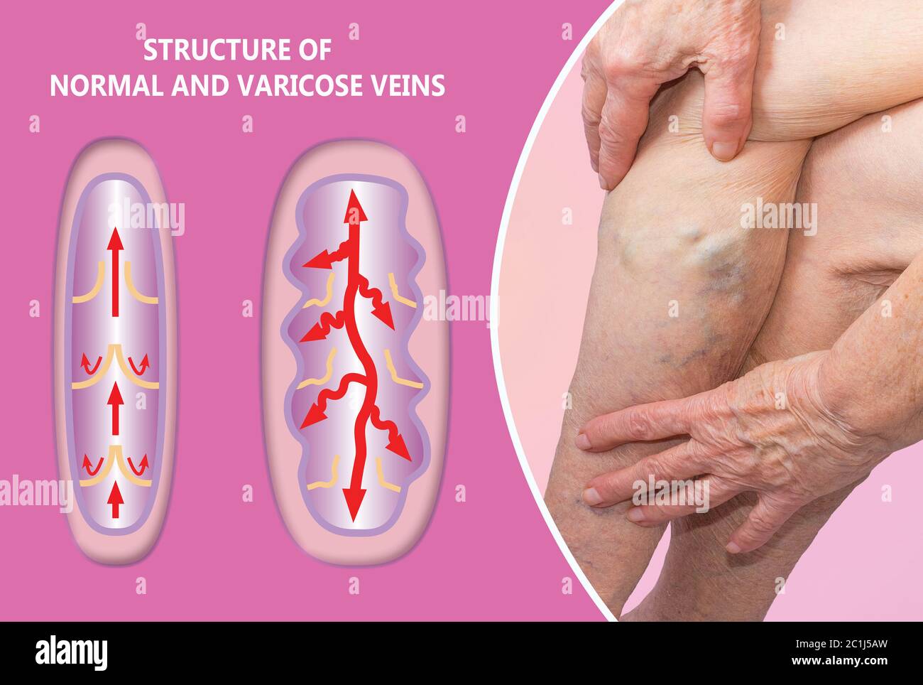 Varices sur les jambes de la femme. La structure des varices et normales. Concept de peau sèche, personnes âgées, varices et thrombose veineuse profonde ou TVP Banque D'Images