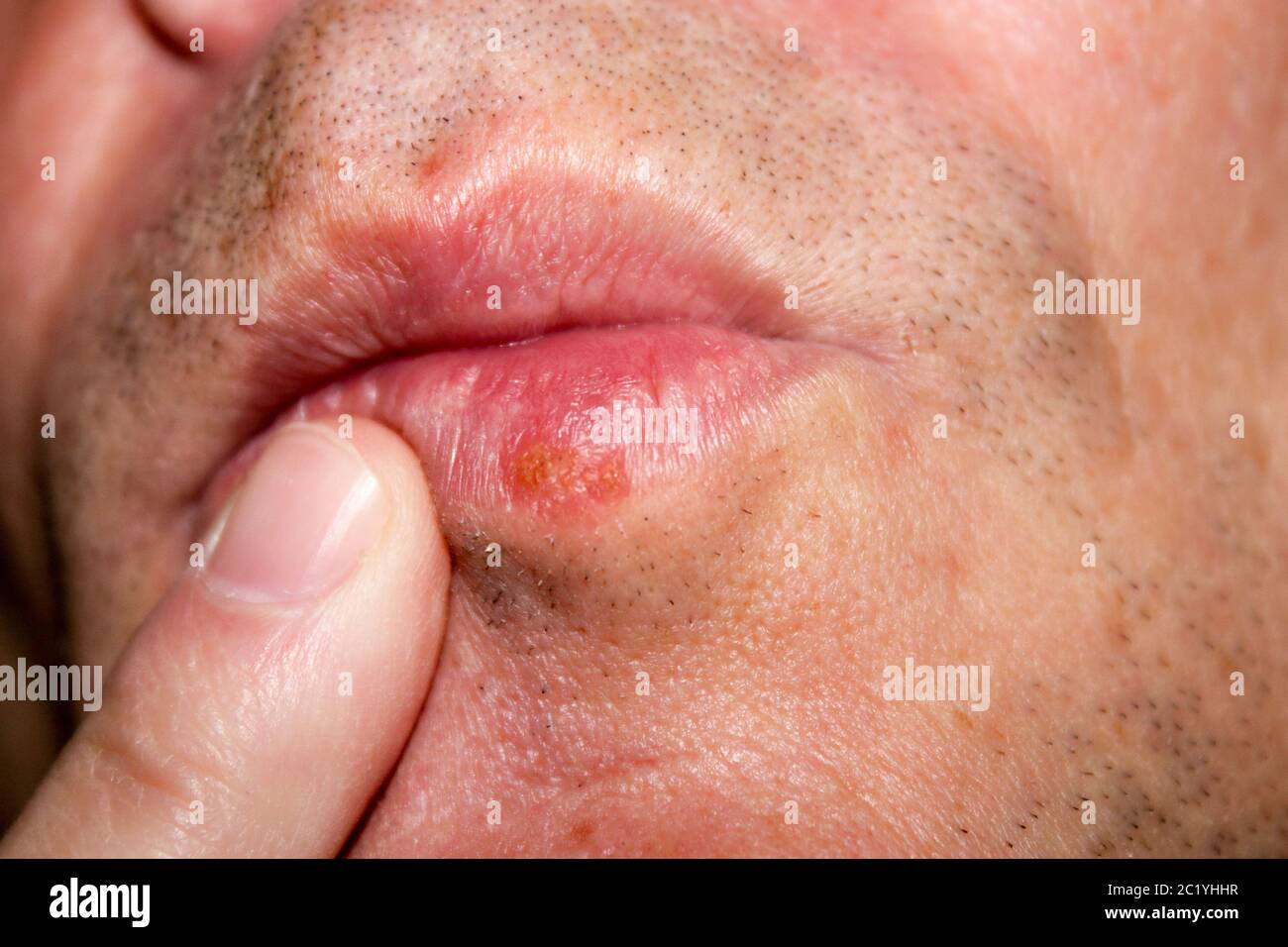 Boutons De Fievre Banque D Image Et Photos Alamy