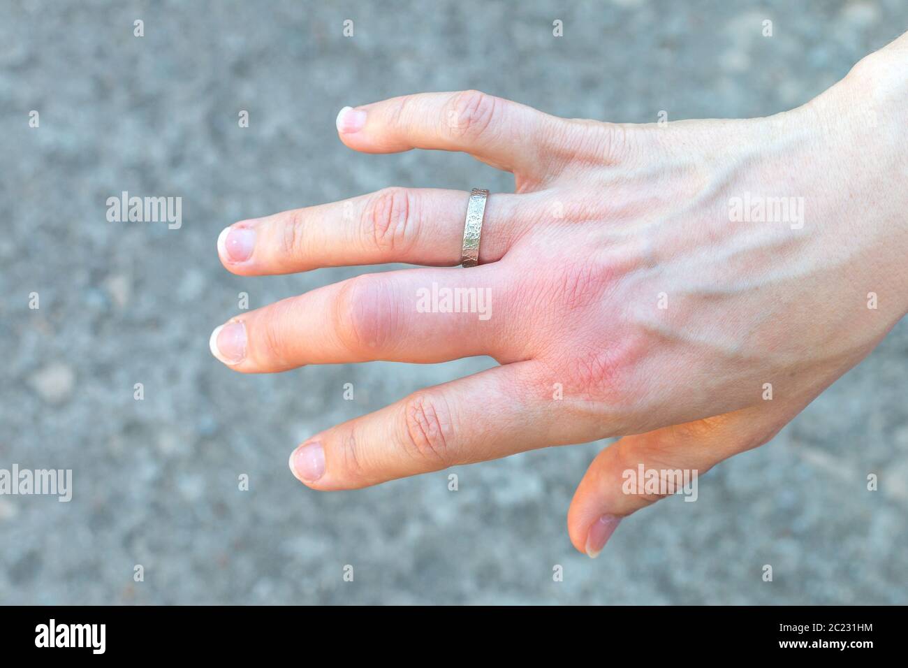 main droite avec un gros doigt central gonflé après une piqûre d'abeille avec un anneau de mariage, élargie en raison de la réaction allergique après une piqûre de guêpe, rouge s. Banque D'Images