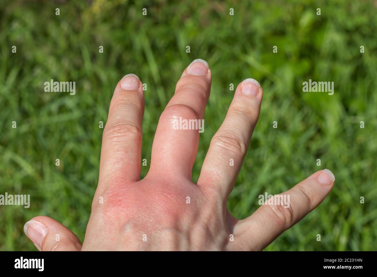 main droite avec un gros doigt central gonflé après une piqûre d'abeille sur un fond vert, plus grand en raison de la réaction allergique après une piqûre de guêpe, sensation rouge Banque D'Images