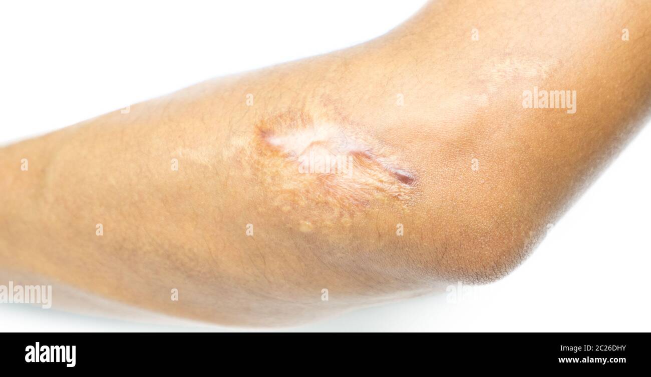 Gros plan de la cicatrice keloid sur le coude de la peau d'homme asiatique après un accident de moto sur fond blanc avec espace de copie. Banque D'Images