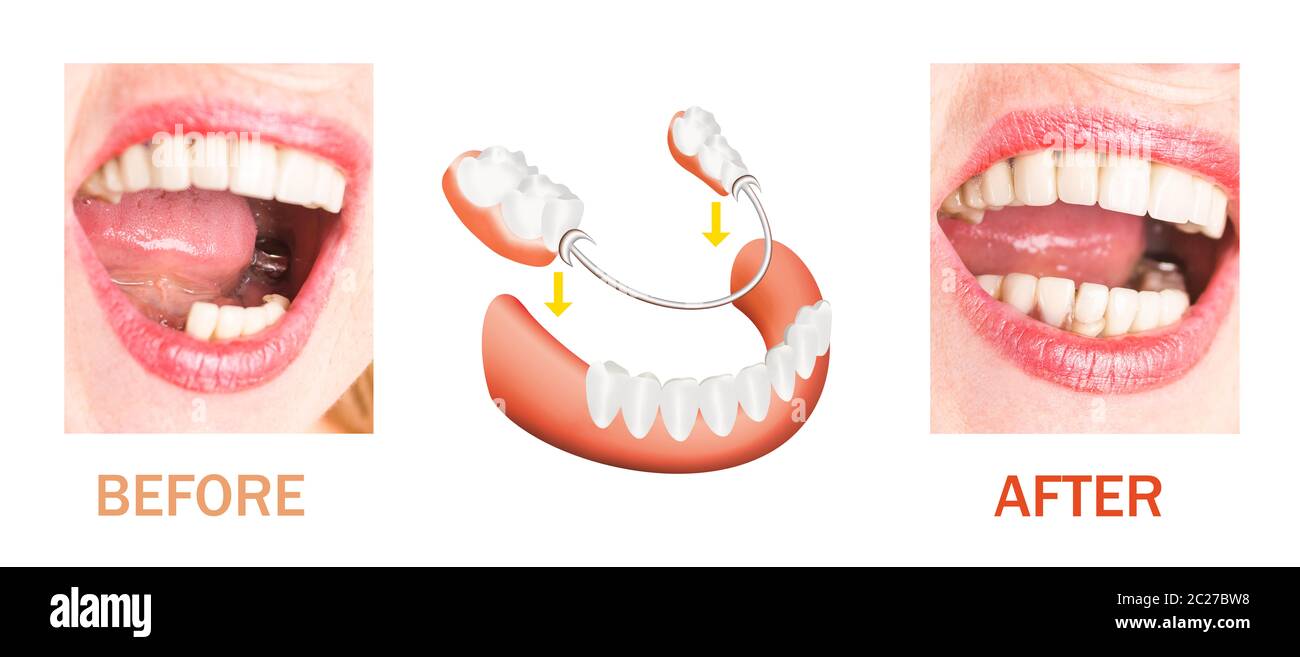 Dentiers Souples  : Veuillez Noter Que Vous Devez Dabord Acheter Le « Kit Dimpression Complète.