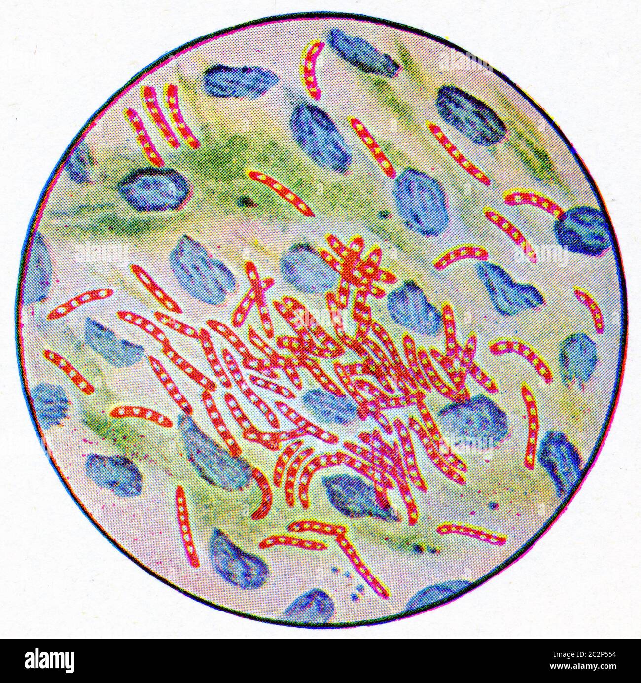 Germes de la tuberculose, illustration gravée d'époque. Banque D'Images