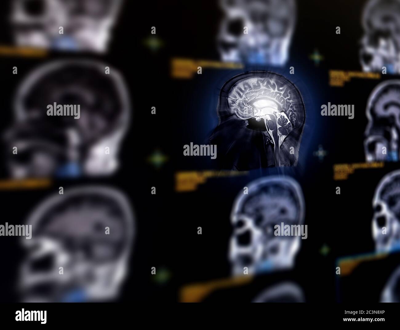 Foyer sélectif du plan sagittal du cerveau IRM pour détecter une variété de conditions cérébrales telles que les tumeurs. Concept IDEA. Banque D'Images