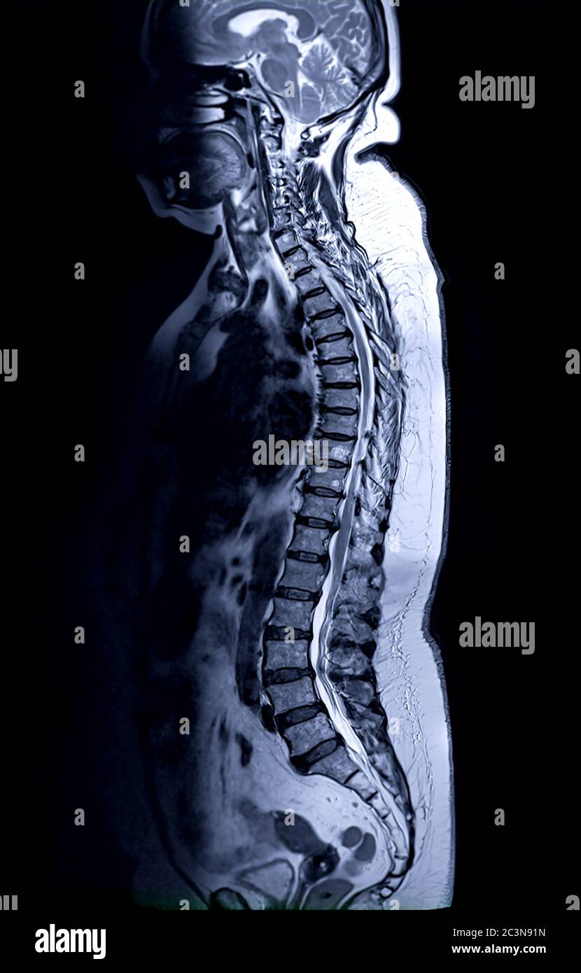 Examen IRM de la colonne vertébrale entière pour le diagnostic de la compression de la moelle épinière. Banque D'Images