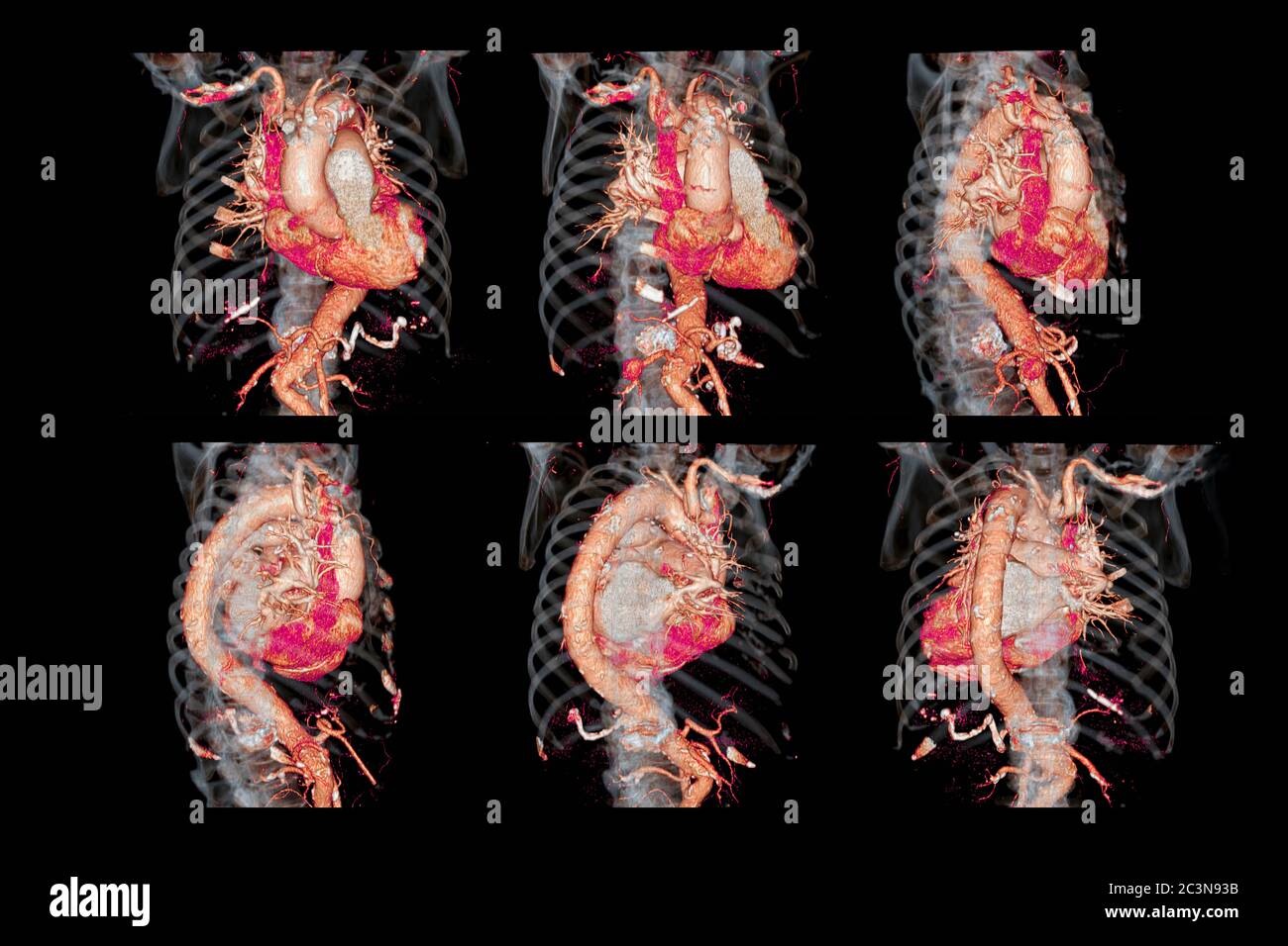 Collection d'images de rendu 3D de l'aorte thoracique CTA pour anévrisme aortique ou AAA et dissection aortique diagnotique Banque D'Images