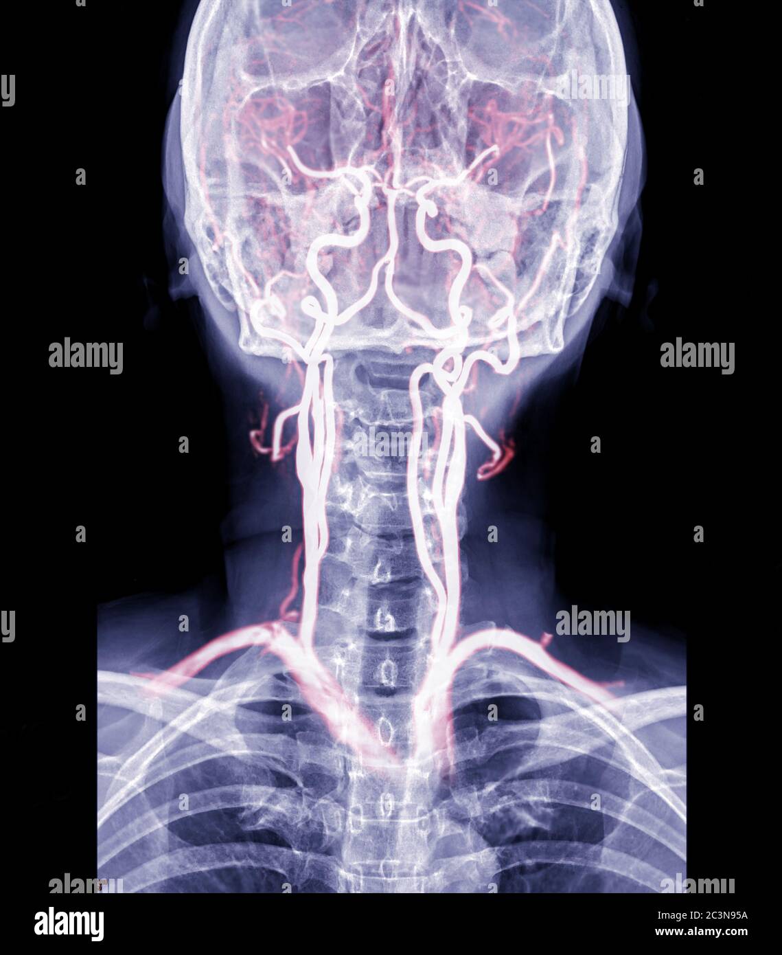 Radiographie du rachis cervical ou radiographie du rachis cervical vue AP avec cta carotide pour une hernie intervertébrale diagnostique. Banque D'Images