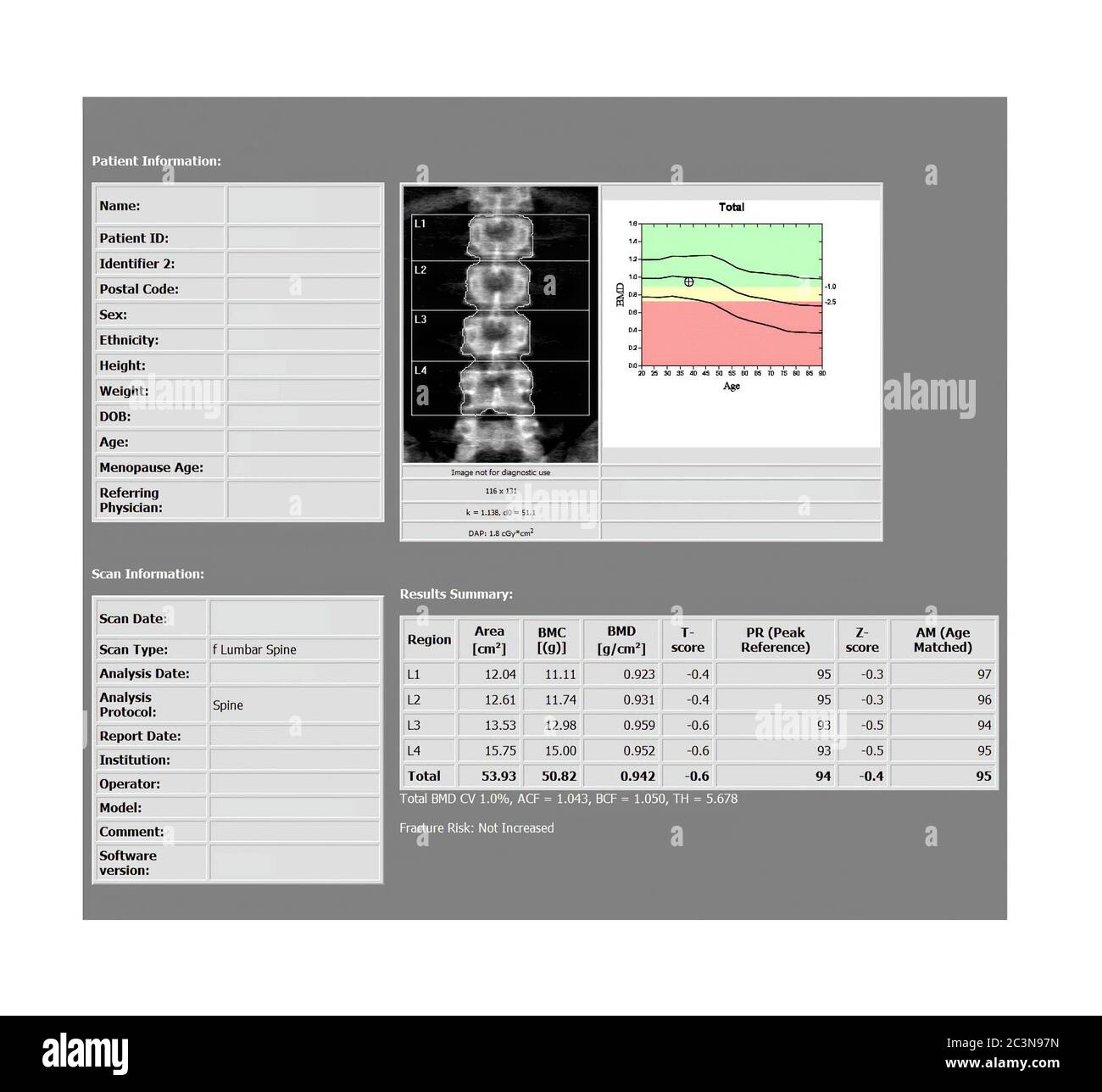 DEXA rapport densitométrique de l'acquisition du rachis lombaire pour Ostéopenia présent, précurseur fréquent de l'ostéoporose. Banque D'Images