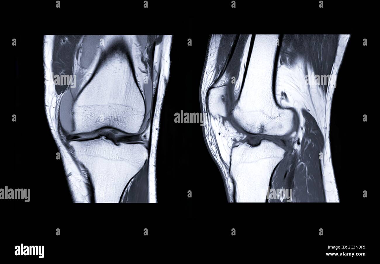 Imagerie par résonance magnétique ou articulation du genou IRM. Comparez les vues frontale et sagittale pour détecter la déchirure ou l'entorse du ligament croisé antérieur (ACL). Banque D'Images