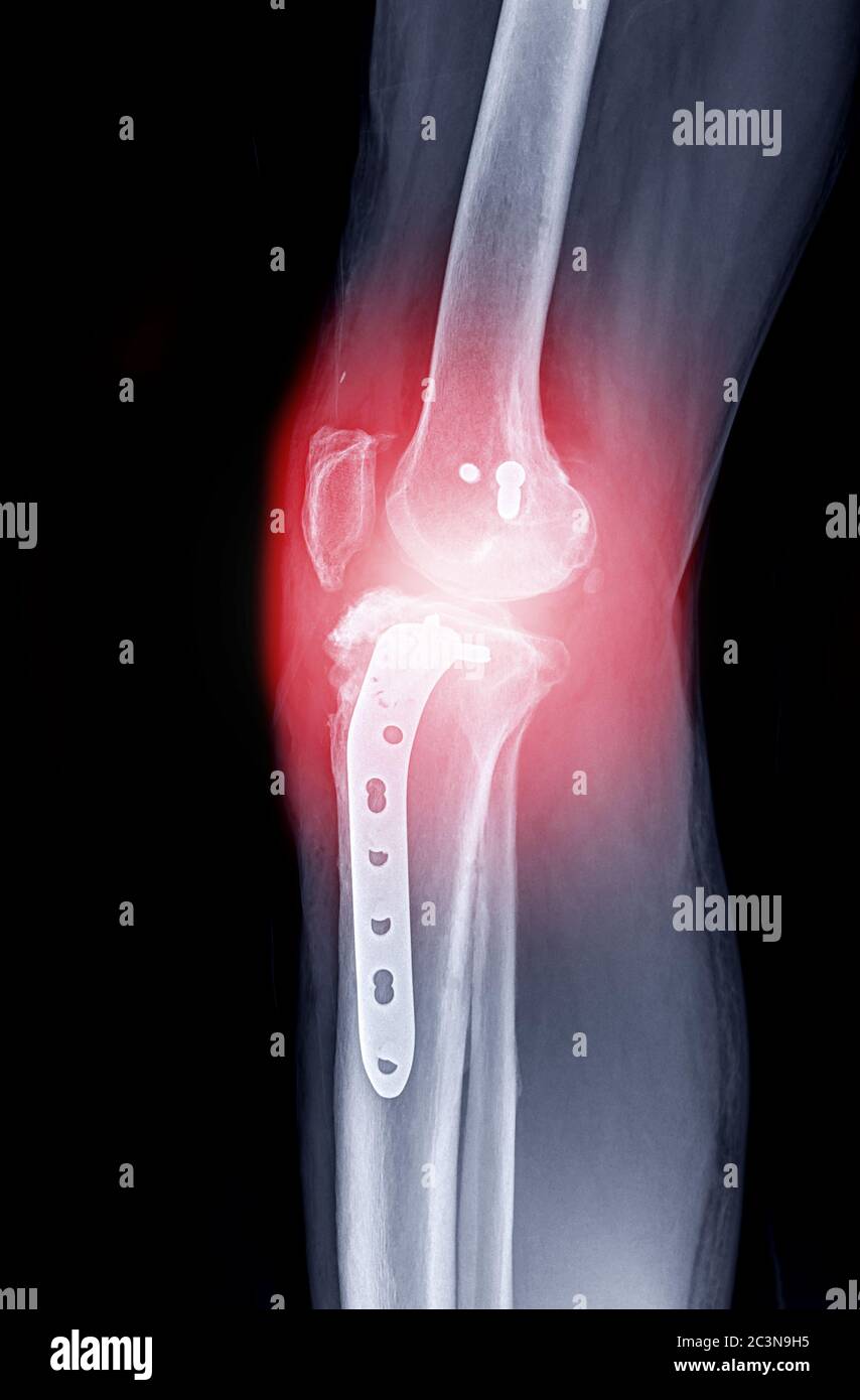 Image radiographique du genou droit vue latérale montrant l'arthroplastie totale du genou et les fractures du plateau tibial avec fixation de la plaque et de la vis. Banque D'Images Image radiographique du genou droit vue latérale montrant l'arthroplastie totale du genou et les fractures du plateau tibial avec fixation de la plaque et de la vis. Banque D'Images