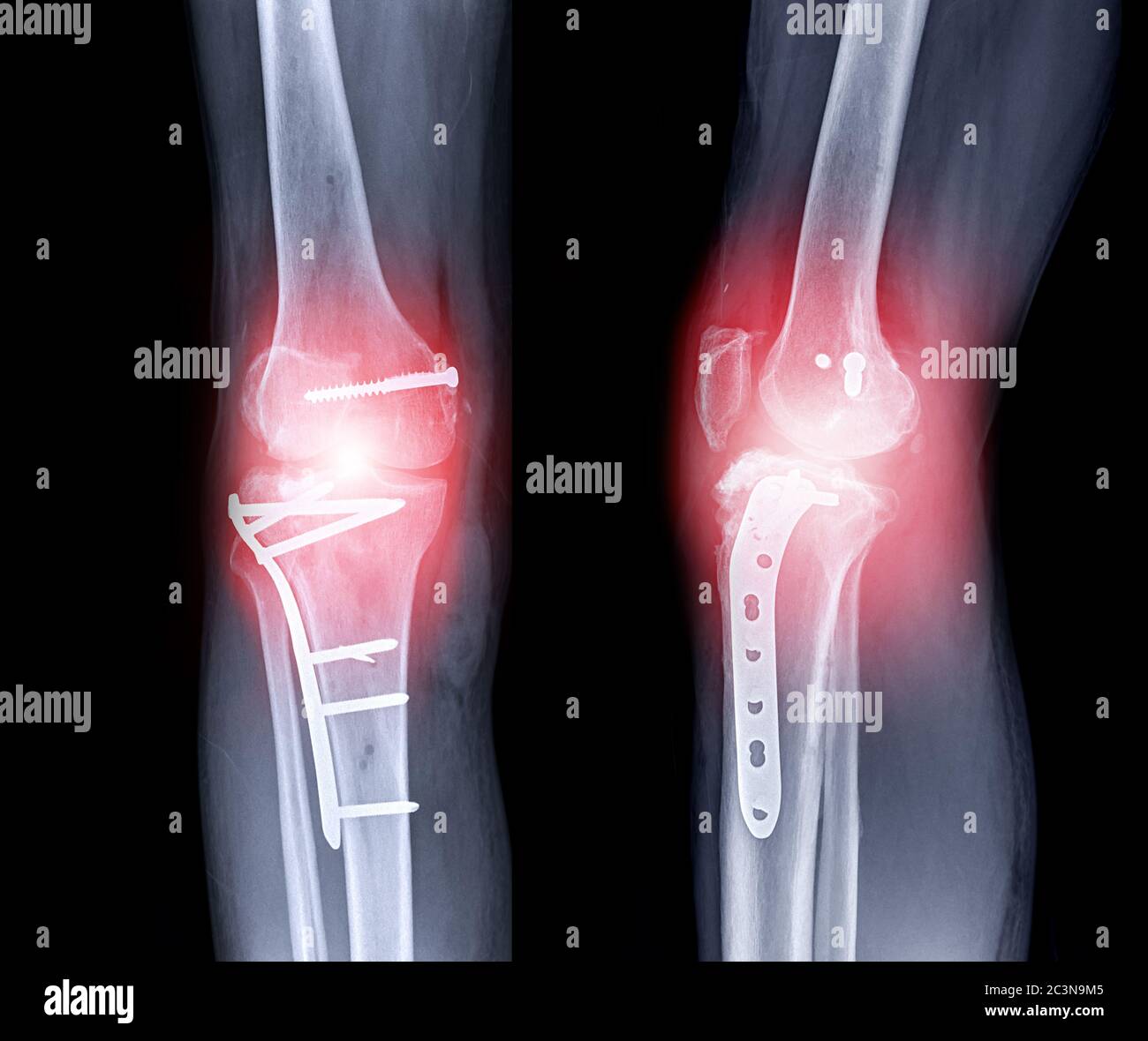 Image radiographique du genou droit AP et vue latérale montrant l ...