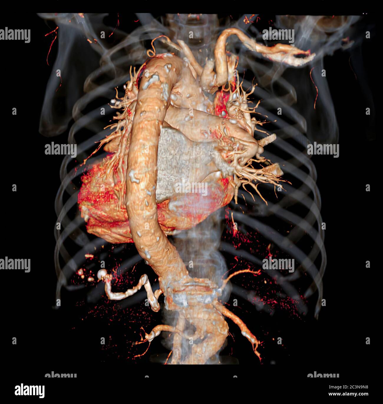 Vue postérieure ou arrière de l'aorte thoracique 3D CTA pour anévrisme aortique ou AAA et dissection aortique diagnotique Banque D'Images