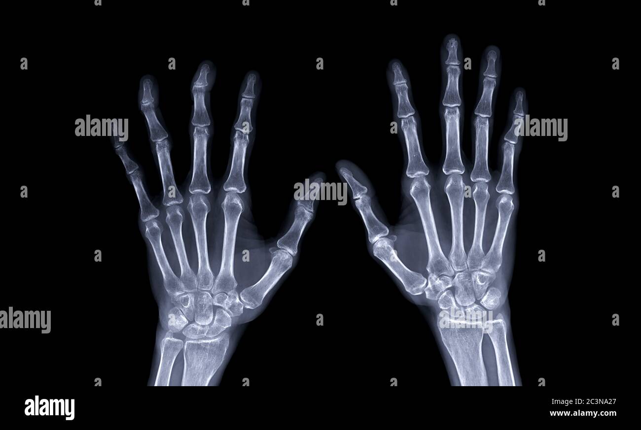 Image radiographique de la vue AP des deux mains isolée sur fond noir pour  diagnostic de la polyarthrite rhumatoïde Photo Stock - Alamy