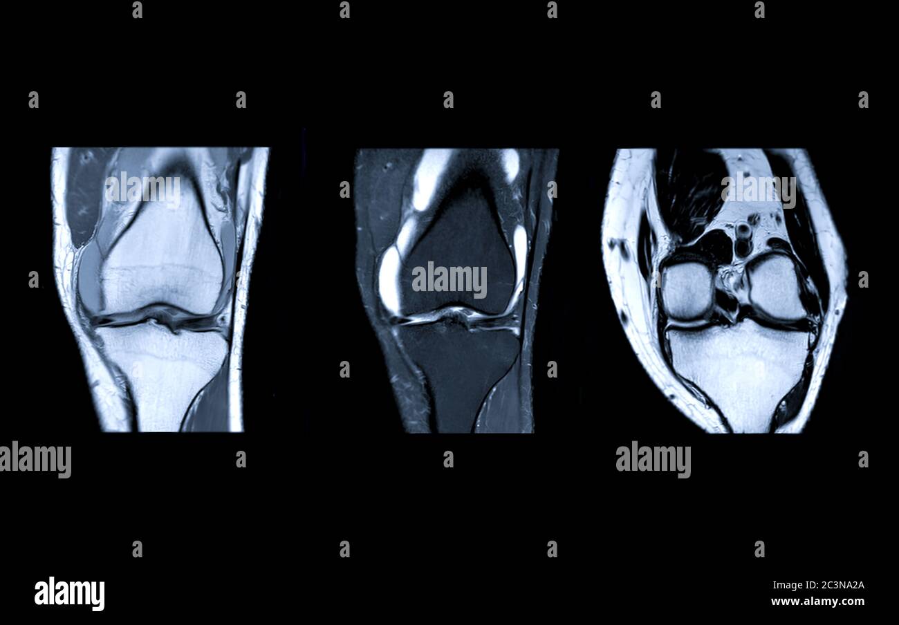 Comparer l'imagerie par résonance magnétique ou l'articulation du genou IRM vue coronale pour détecter la déchirure ou l'entorse du ligament croisé antérieur (ACL). Banque D'Images