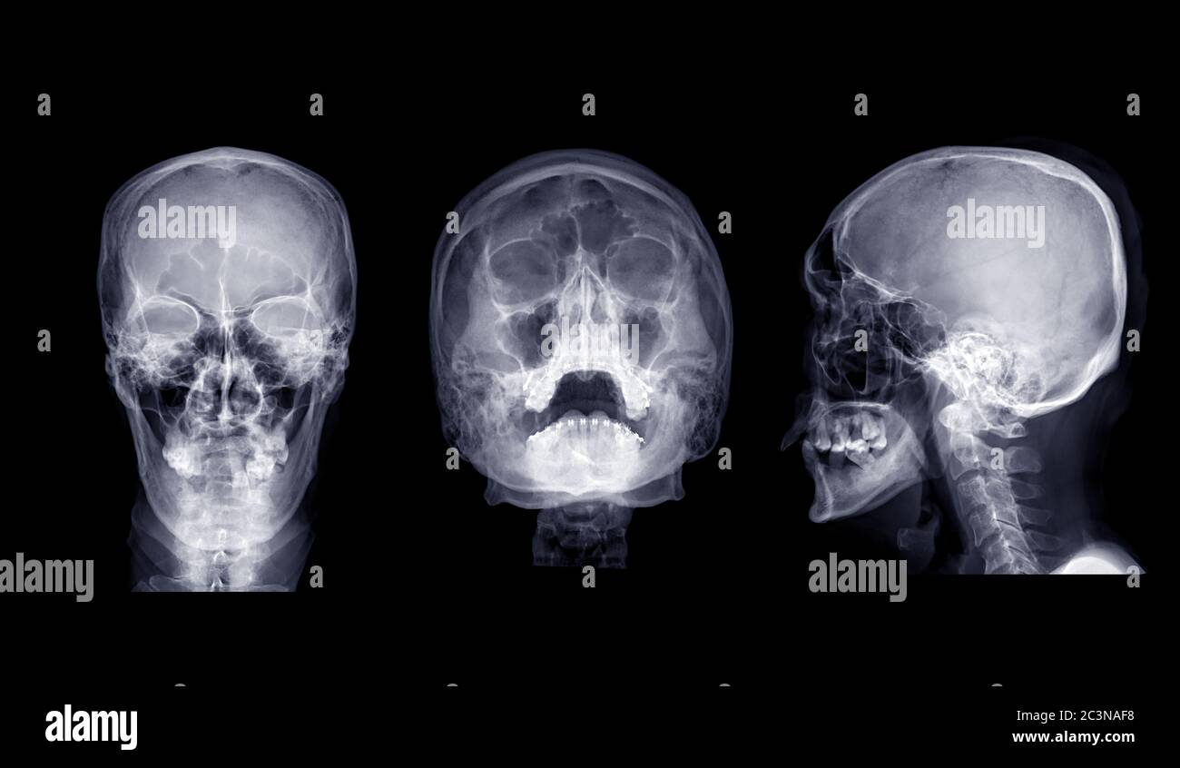 Collection d'images radiographiques du crâne humain AP , vue de l'eau et vue latérale isolée sur fond noir. Banque D'Images