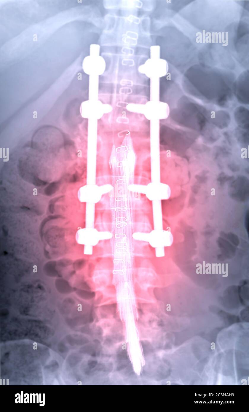 la myélographie est particulièrement sensible à la détection de petites hernies discales comprimant les nerfs de la colonne vertébrale . Banque D'Images