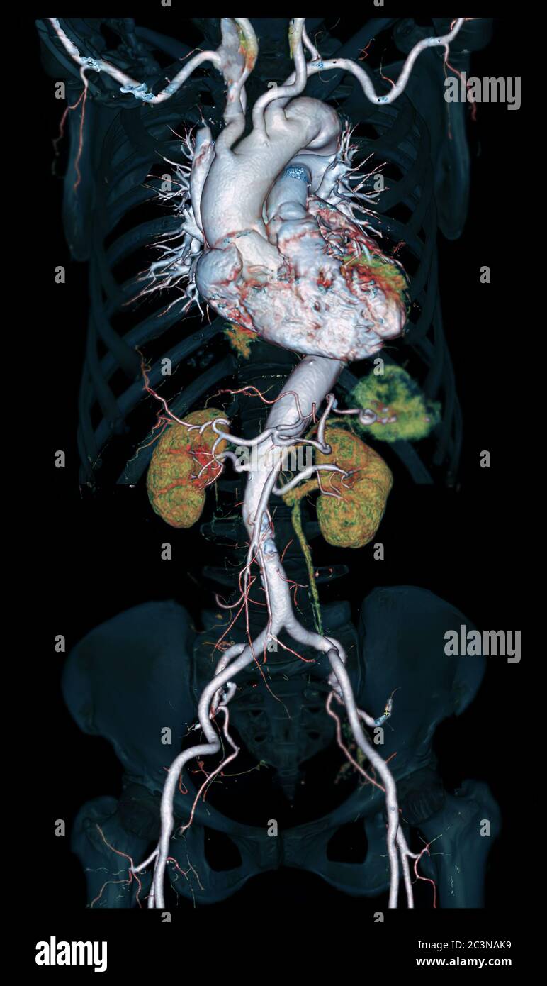 Image de rendu 3D de l'aorte complète CTA sur fond noir pour détecter un anévrisme aortique. Banque D'Images