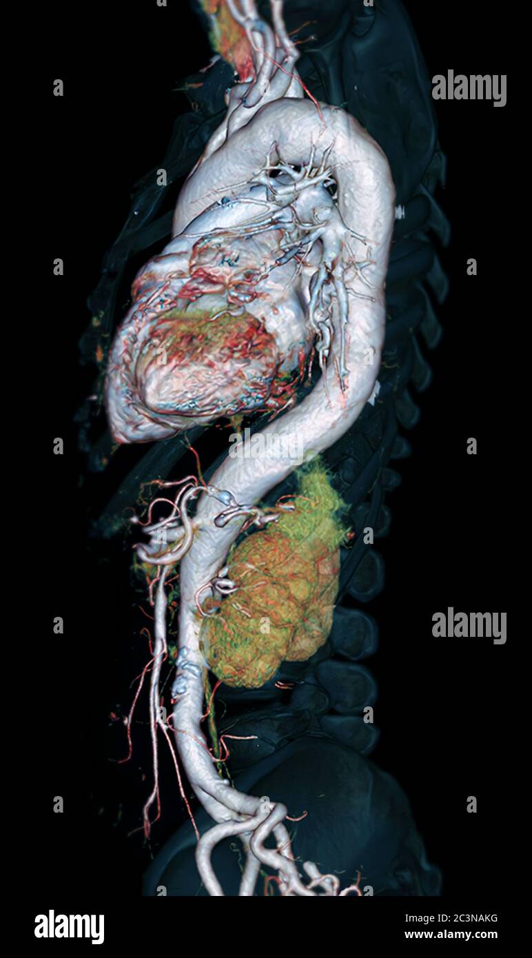 Vue latérale de l'aorte entière CTA 3D sur fond noir pour détecter un anévrisme aortique. Banque D'Images