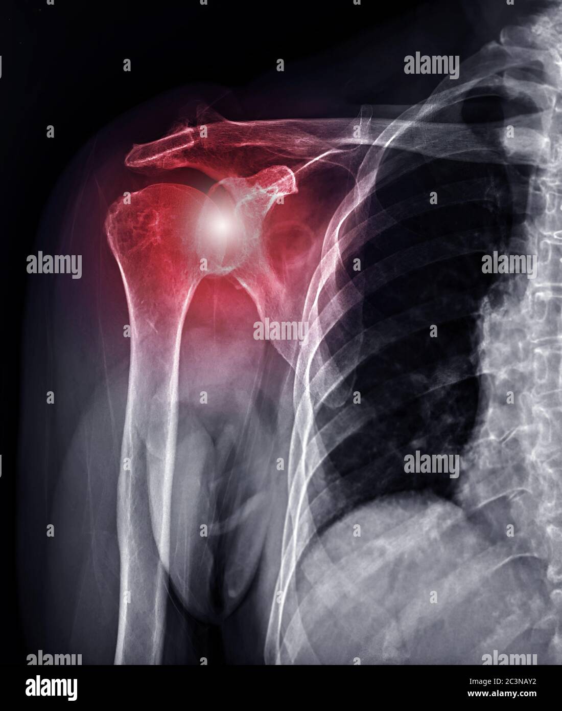 Articulation de l'épaule à rayons X pour le diagnostic de la luxation de l'articulation de l'épaule. Banque D'Images