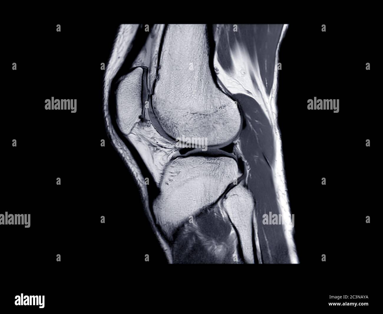 Vue sagittale d'imagerie par résonance magnétique ou articulation du genou IRM pour détecter la déchirure ou l'entorse du ligament croisé antérieur (ACL). Banque D'Images
