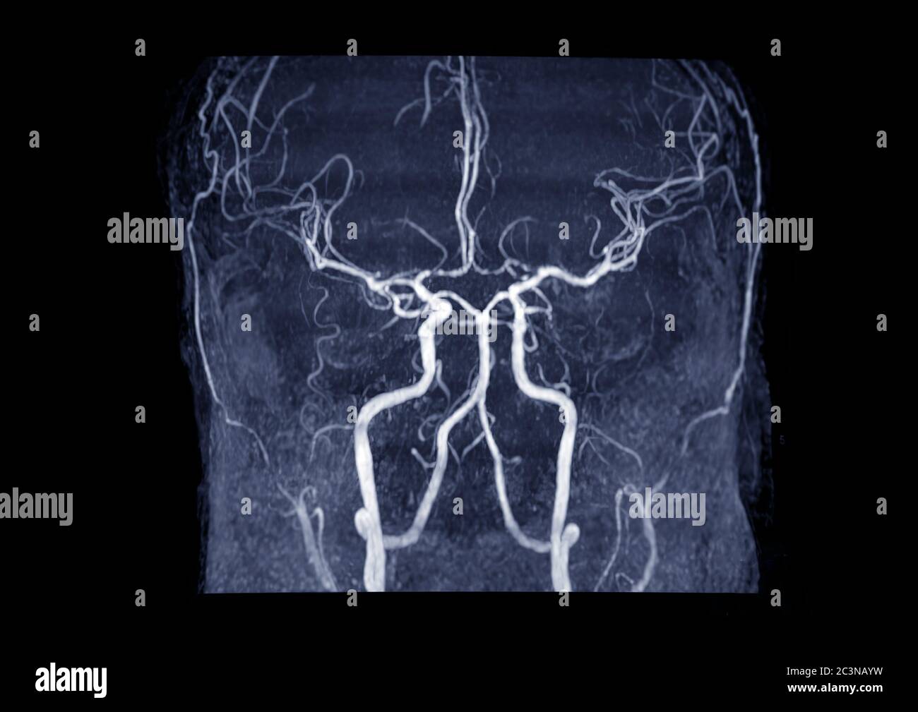 ARM angiographie par résonance magnétique ou cérébrale ( ARM ) de l ...