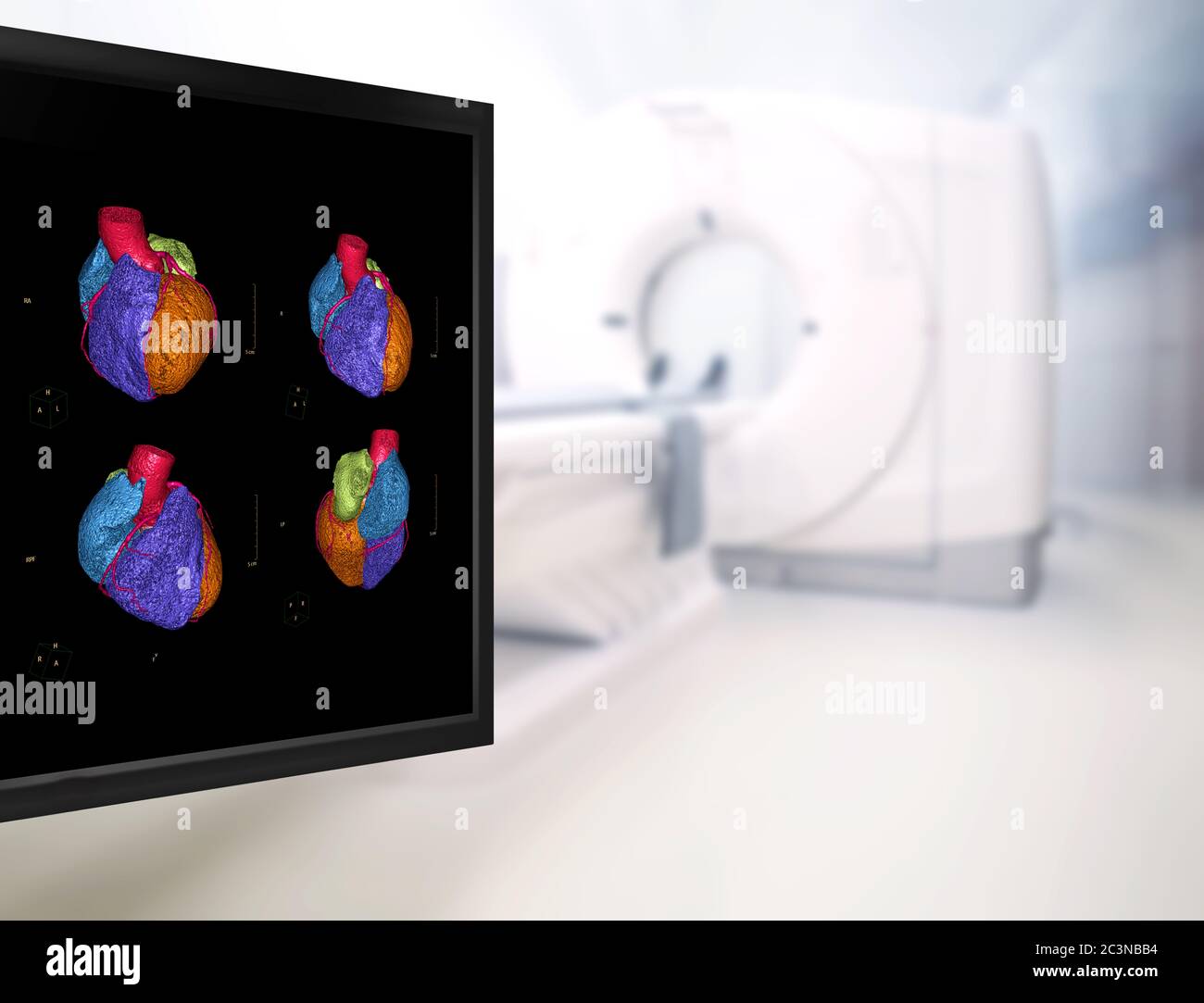 Foyer sélectif de l'image de rendu 3D de l'artère coronaire CTA sur le mornitor dans la salle d'examen CT de l'hôpital. Banque D'Images