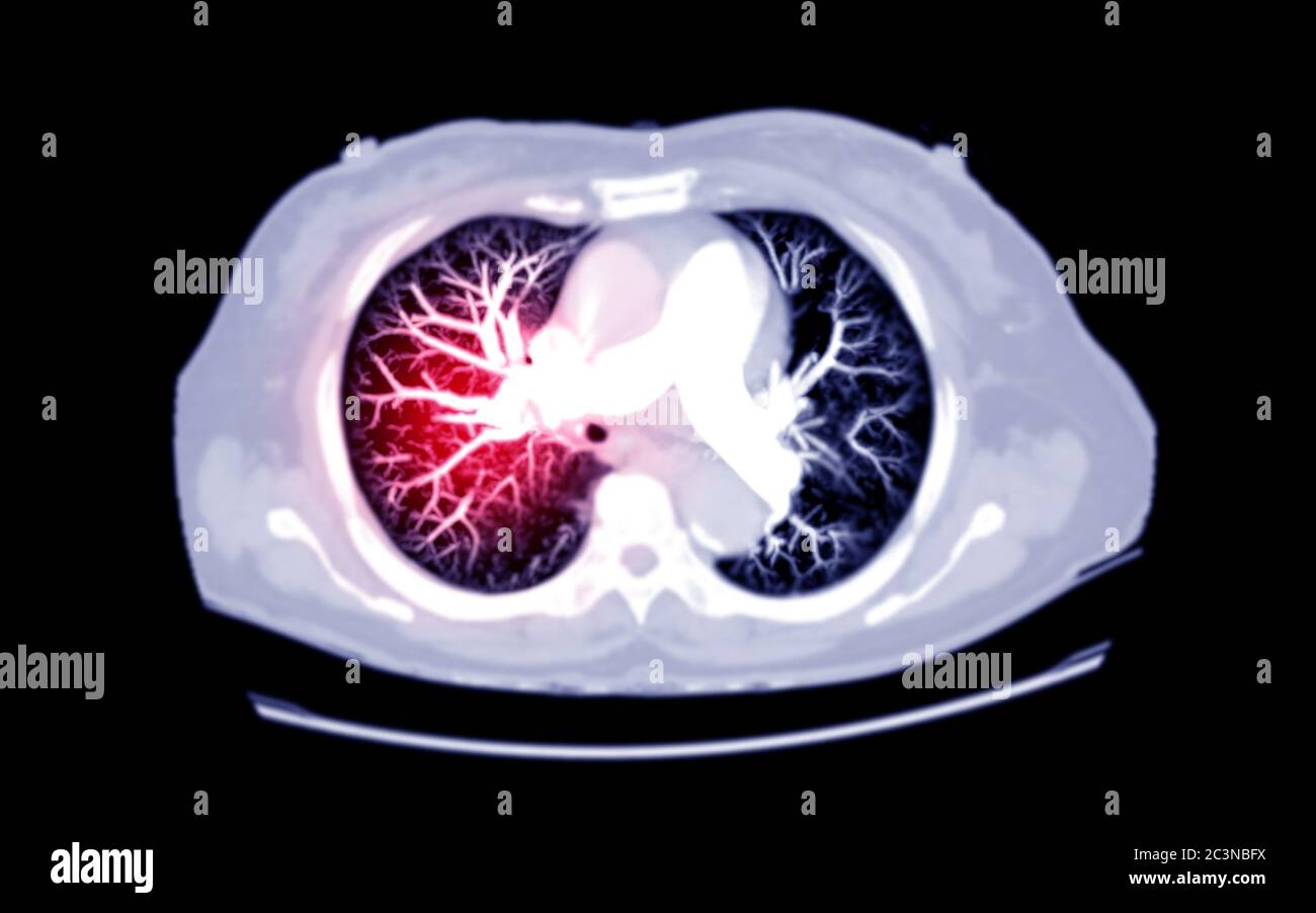 Foyer sélectif de la vue MIP AXIALE CT du thorax pour l'embolie pulmonaire (PE) diagnostique, le cancer du poumon et le covid-19. . Banque D'Images
