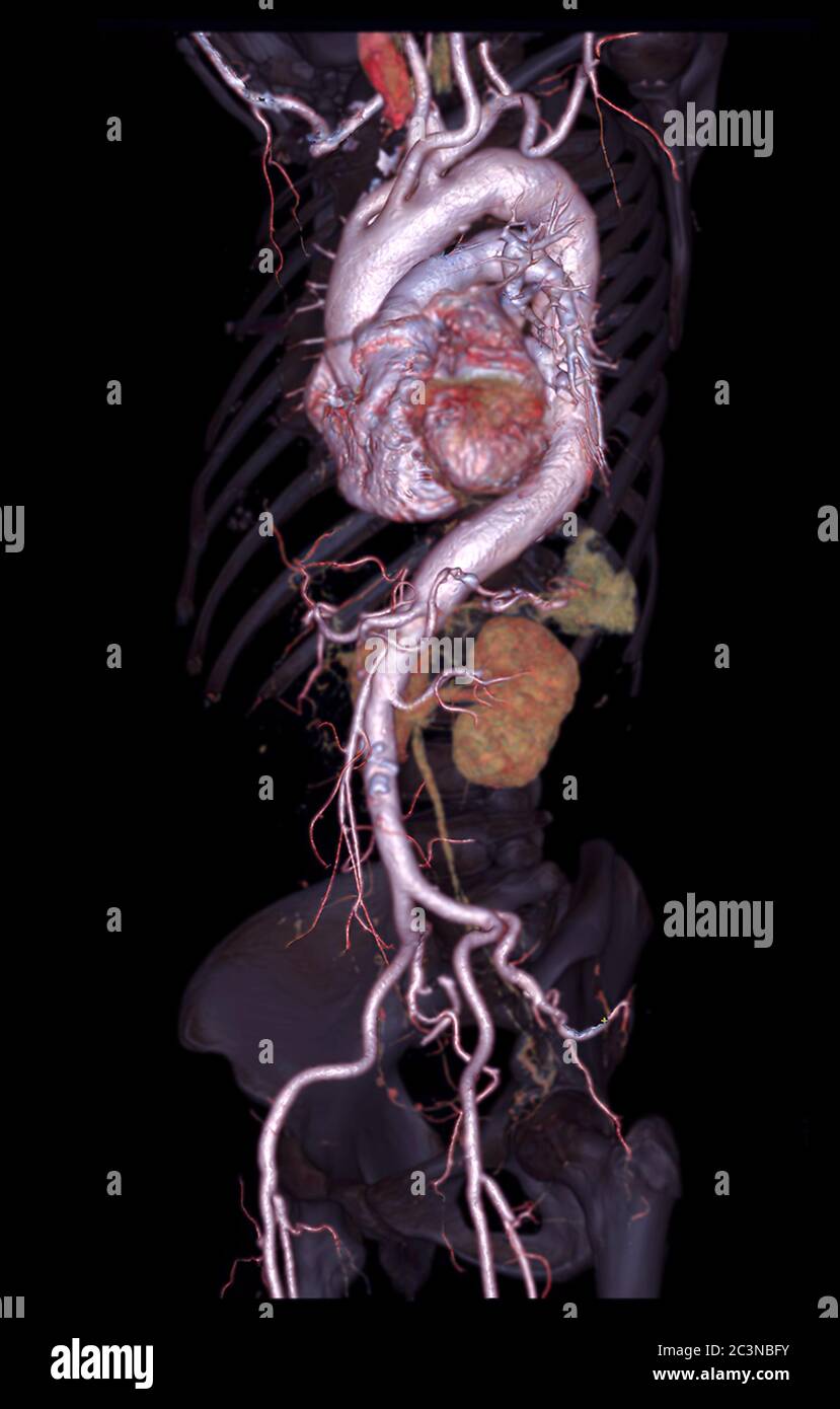 CTA aorte abdominale image de rendu 3D sur squelette transparent . Banque D'Images