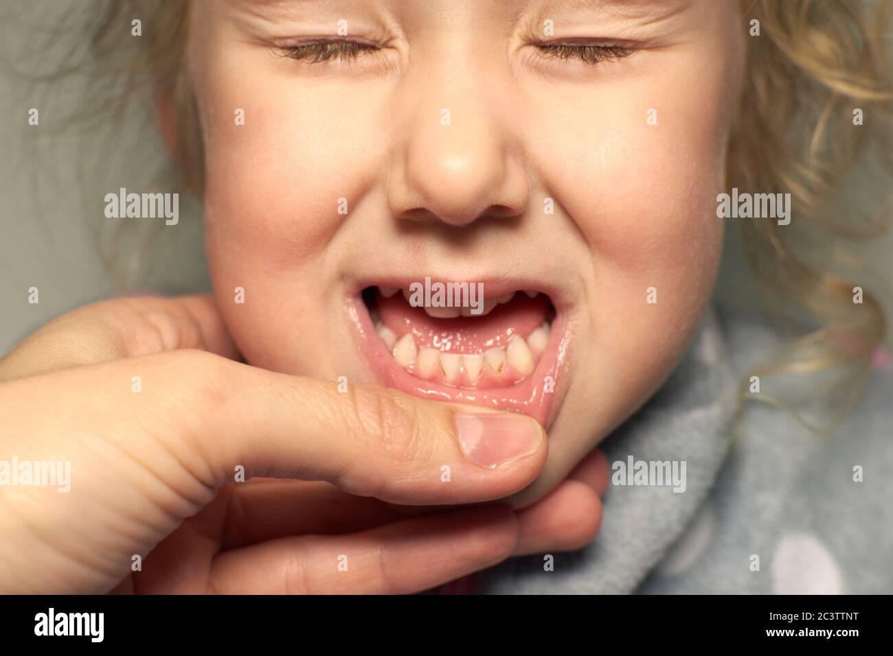 Gros plan des dents malsaines de bébé. Fille bouche ouverte montrant carie dents pourriture, mauvaises dents. Banque D'Images